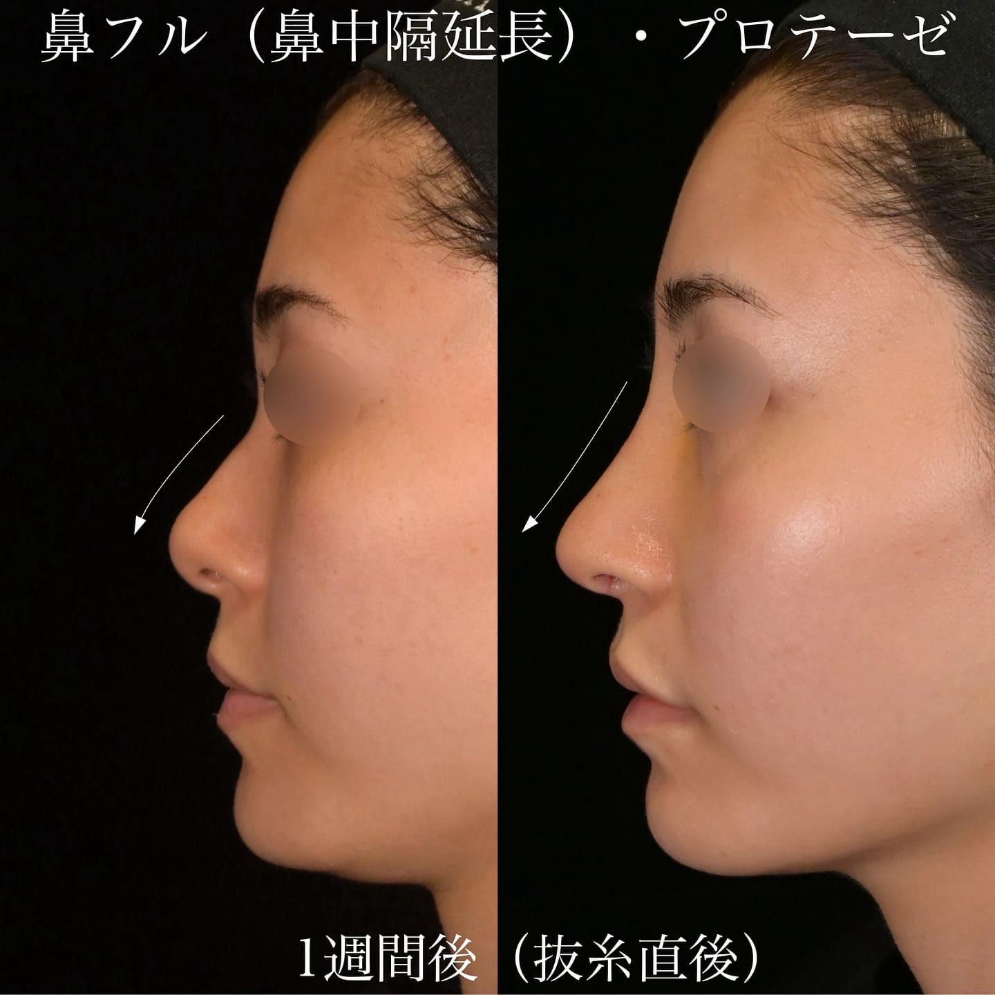 上木原医師による鼻整形の術前/術後1週間