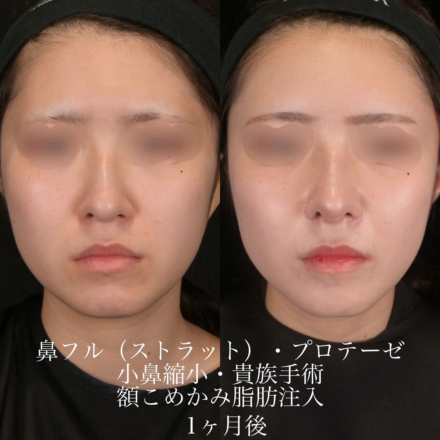 上木原医師による鼻整形の術前/術後1ヶ月 术后 