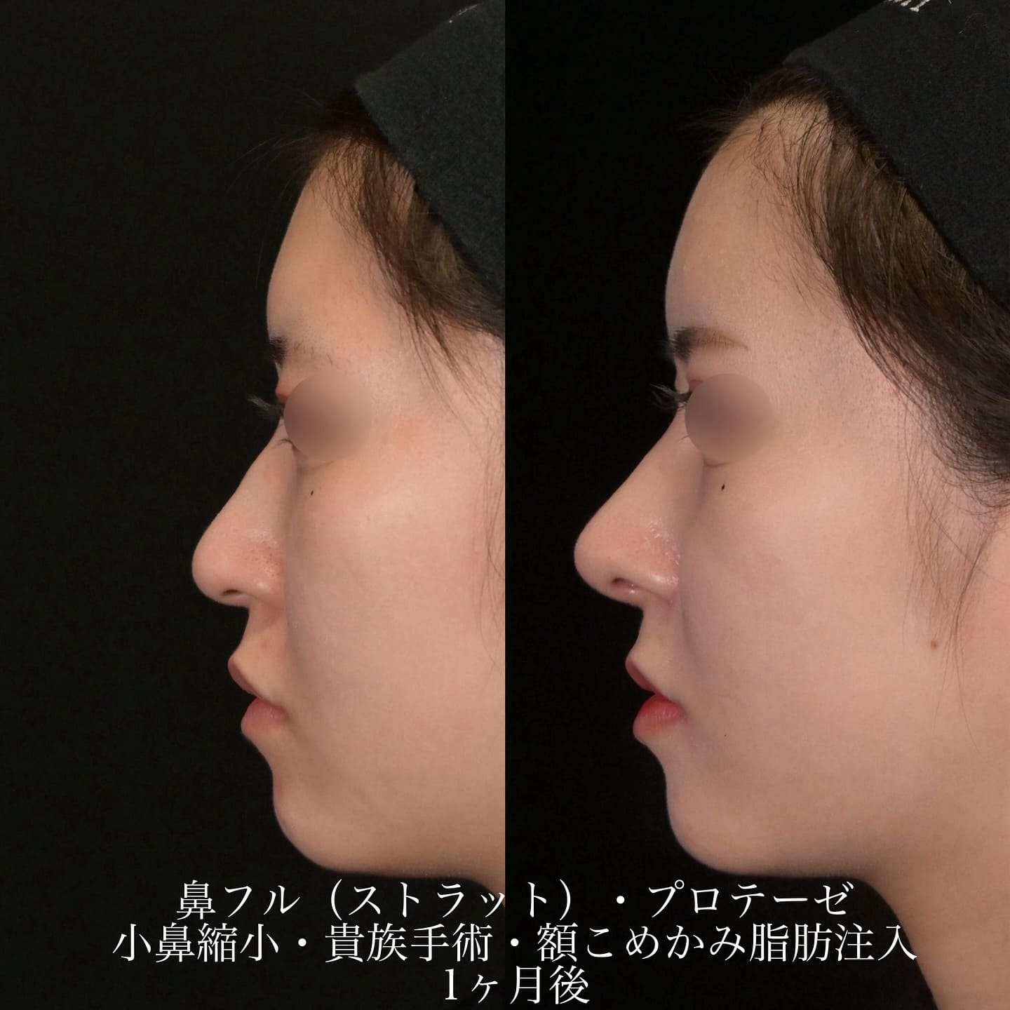 上木原医師による鼻整形の術前/術後1ヶ月