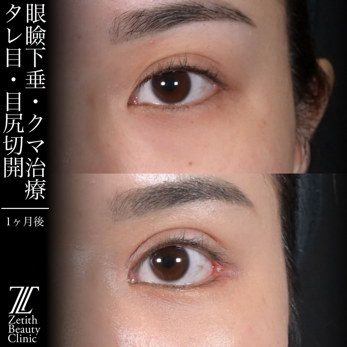 上木原医師による鼻整形の術前/術後1ヶ月 术后 