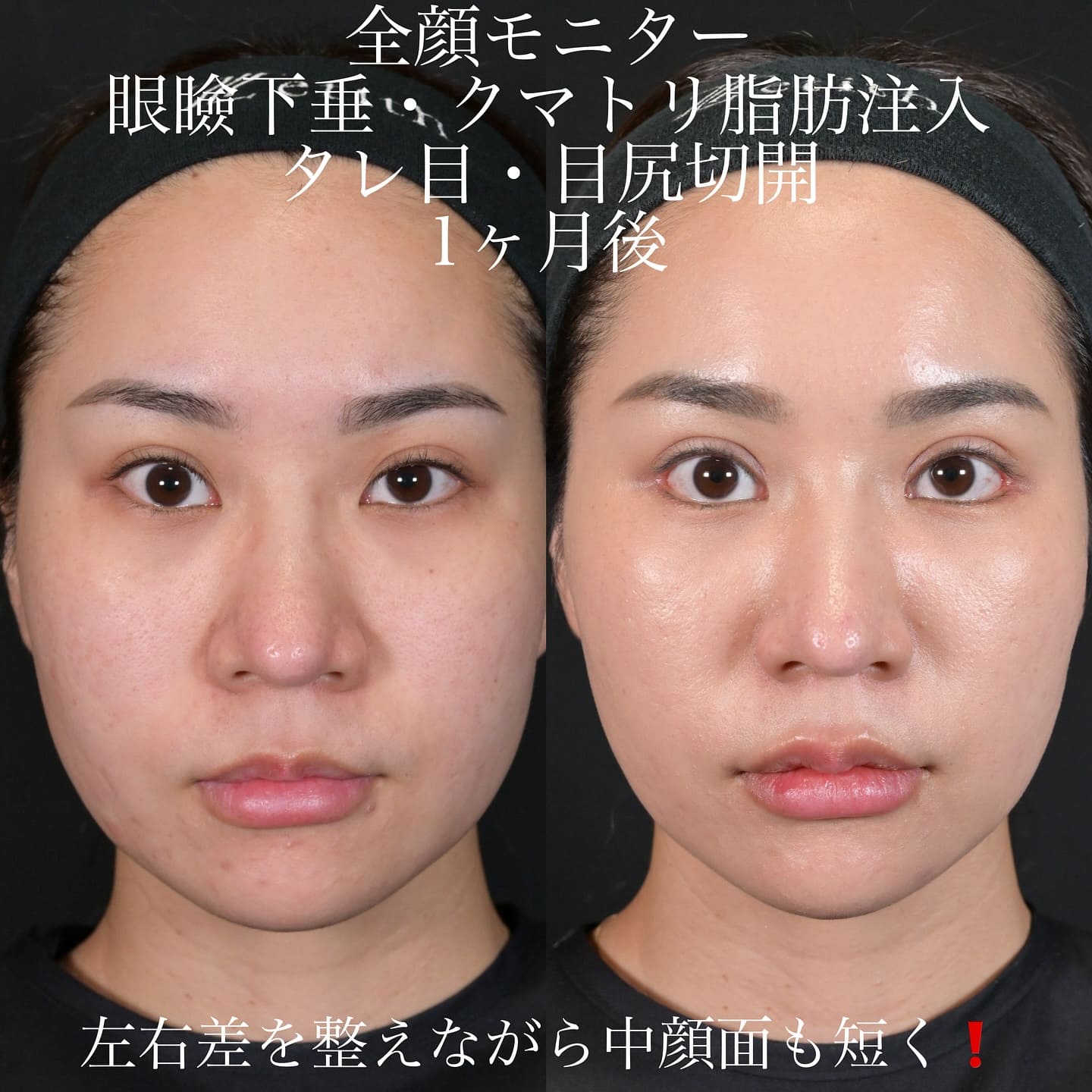 上木原医師による鼻整形の術前/術後1ヶ月