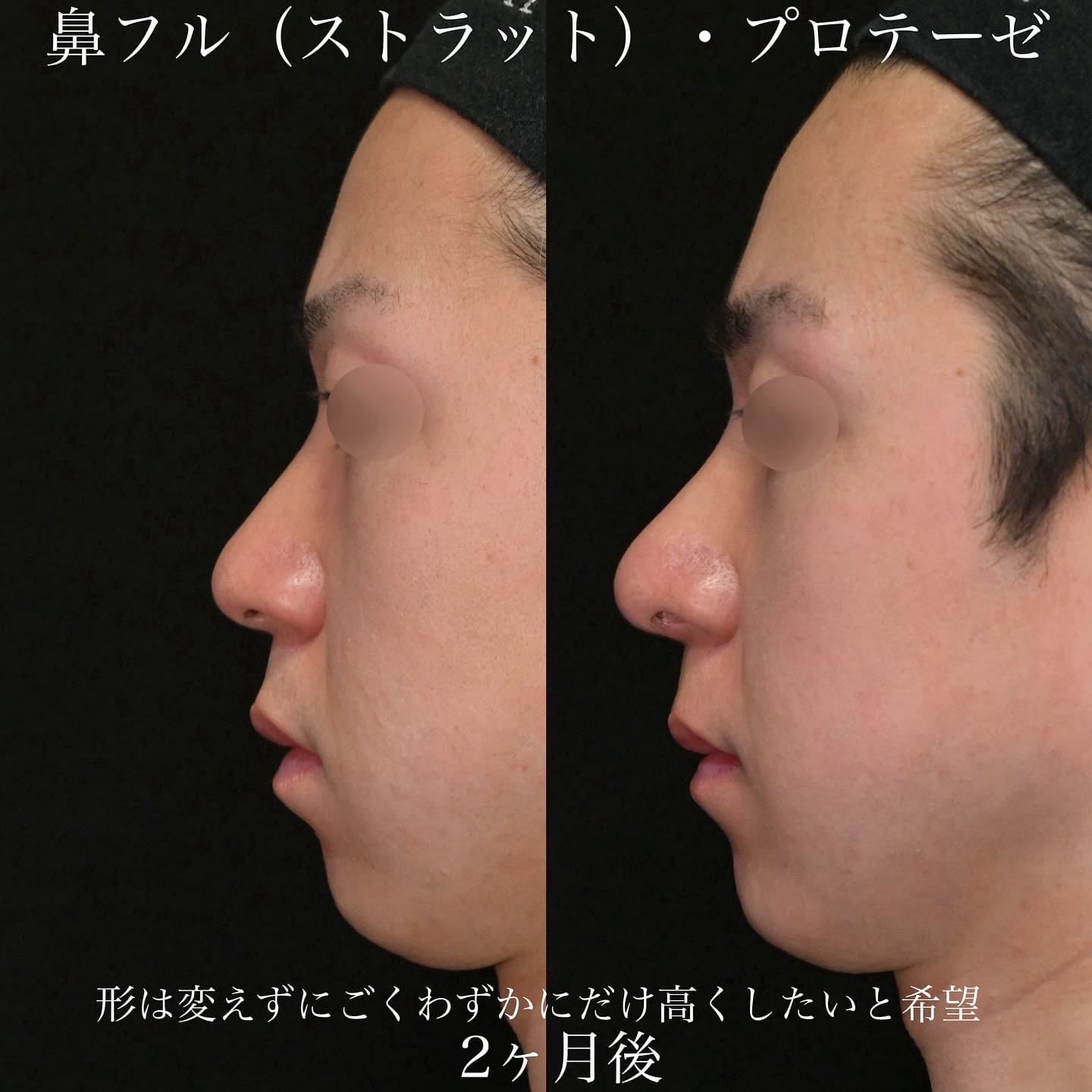 上木原医師による鼻整形の術前/術後2ヶ月 术后 