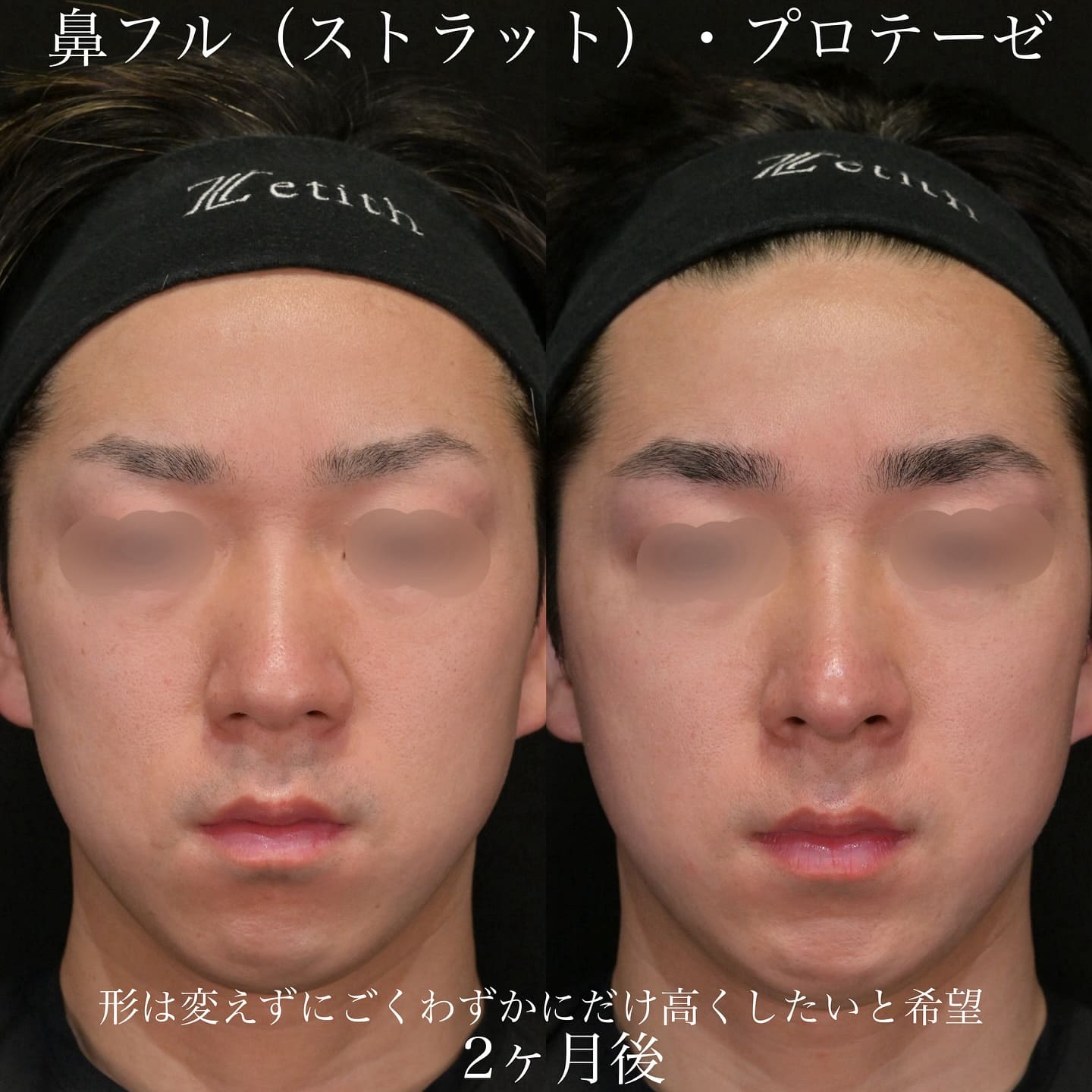 上木原医師による鼻整形の術前/術後2ヶ月