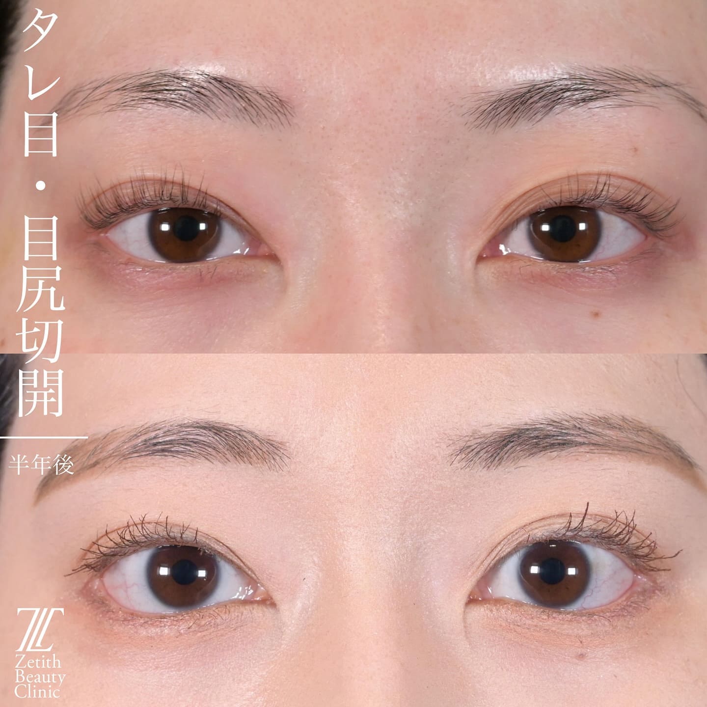 上木原医師による目元整形の術前/術後6ヶ月
