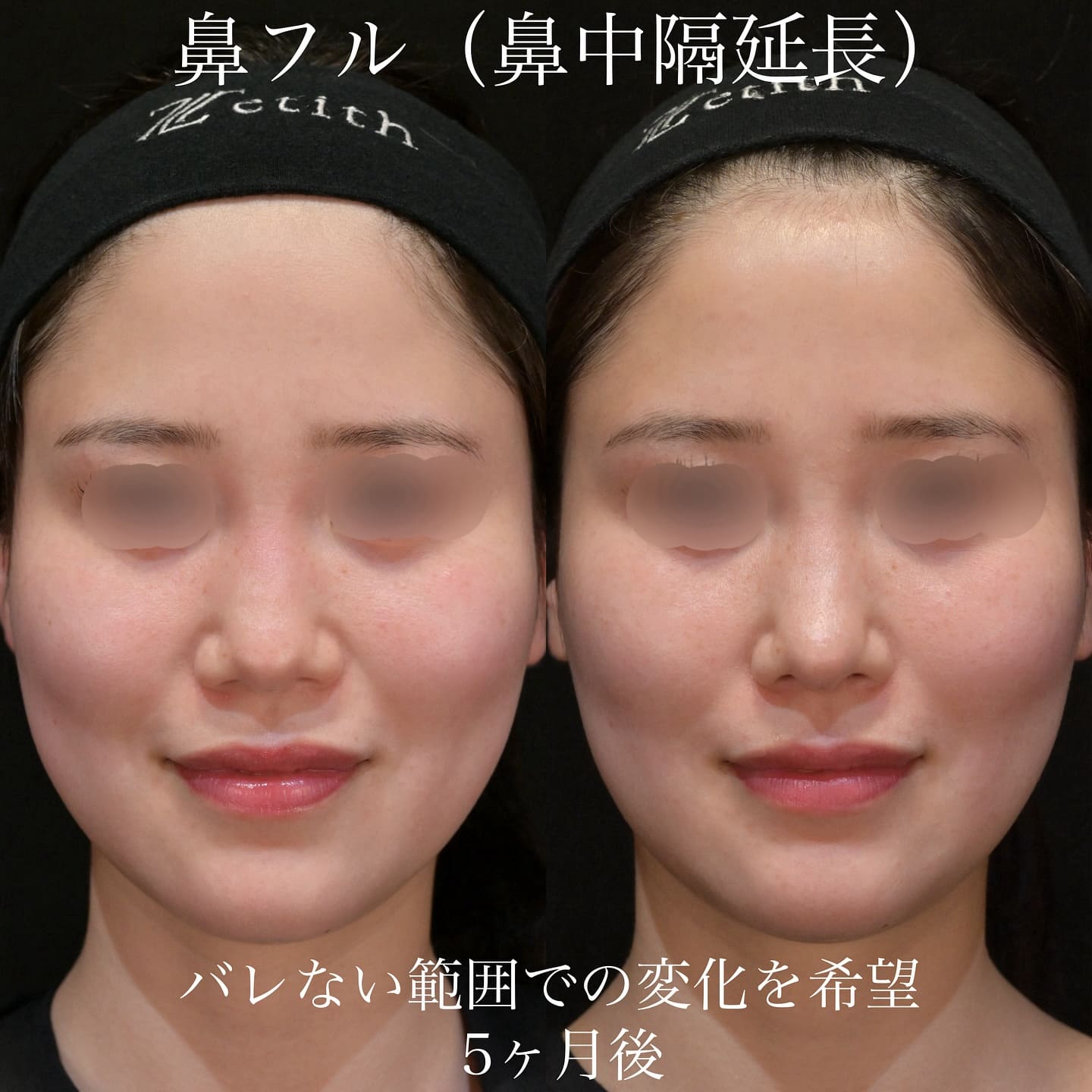 上木原医師による鼻整形の術前/術後5ヶ月