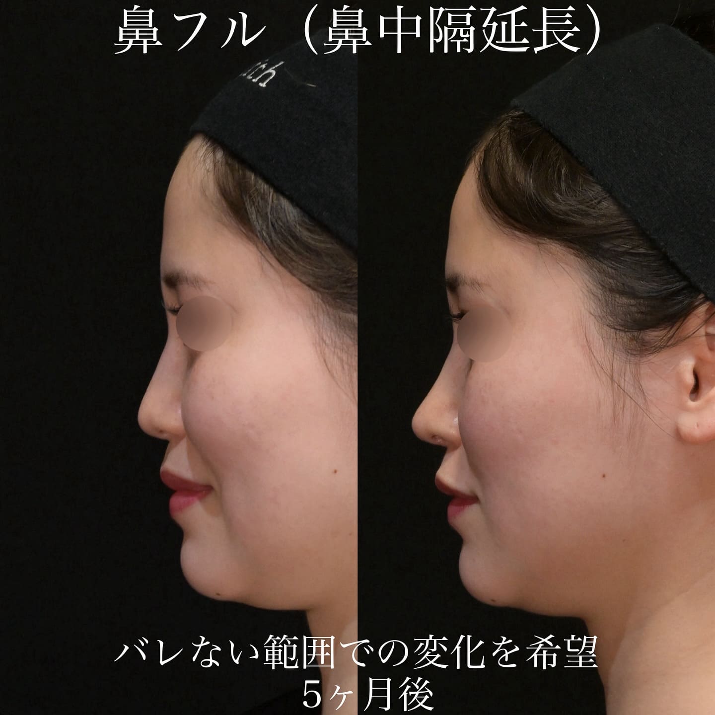 上木原医師による鼻整形の術前/術後5ヶ月 Дараа 
