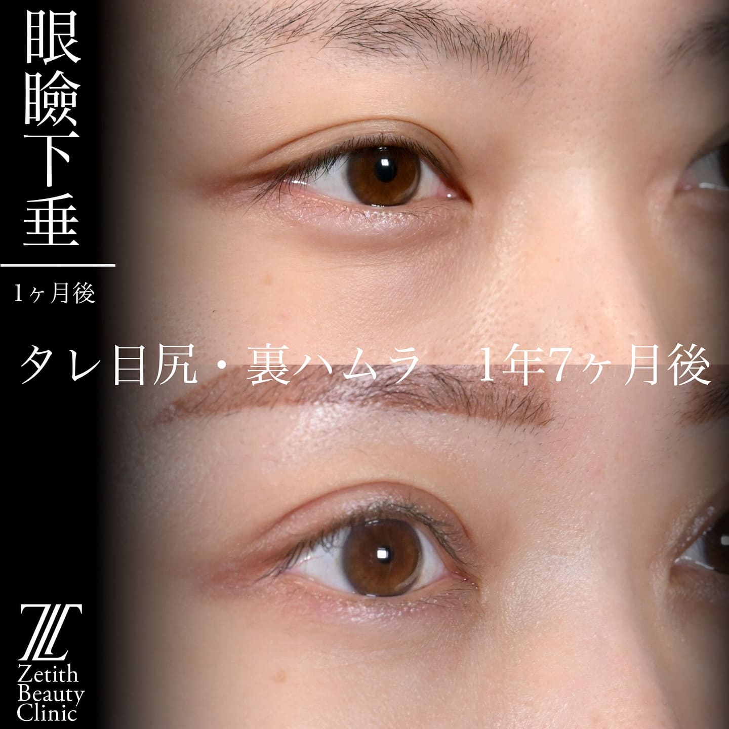 上木原医師による目元整形の術前/術後1ヶ月 术后 