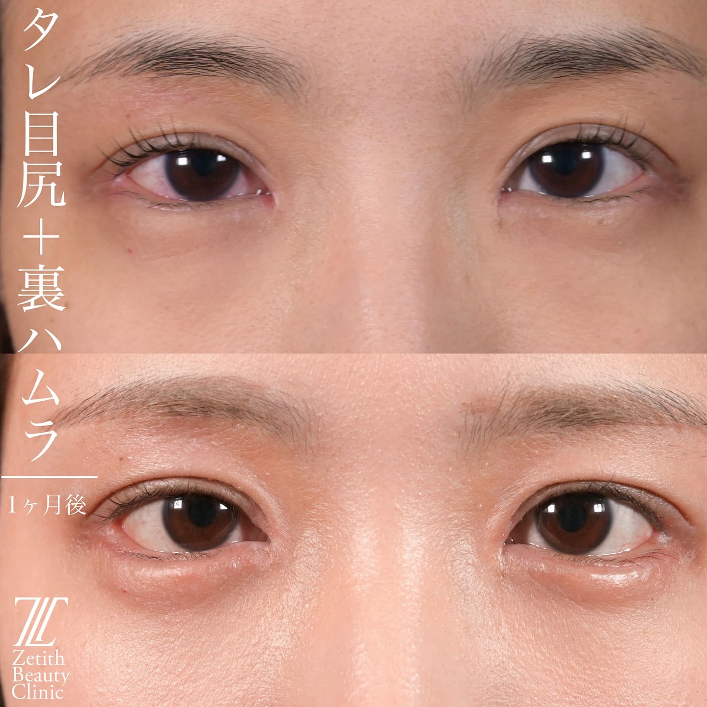 上木原医師による目元整形の術前/術後1ヶ月