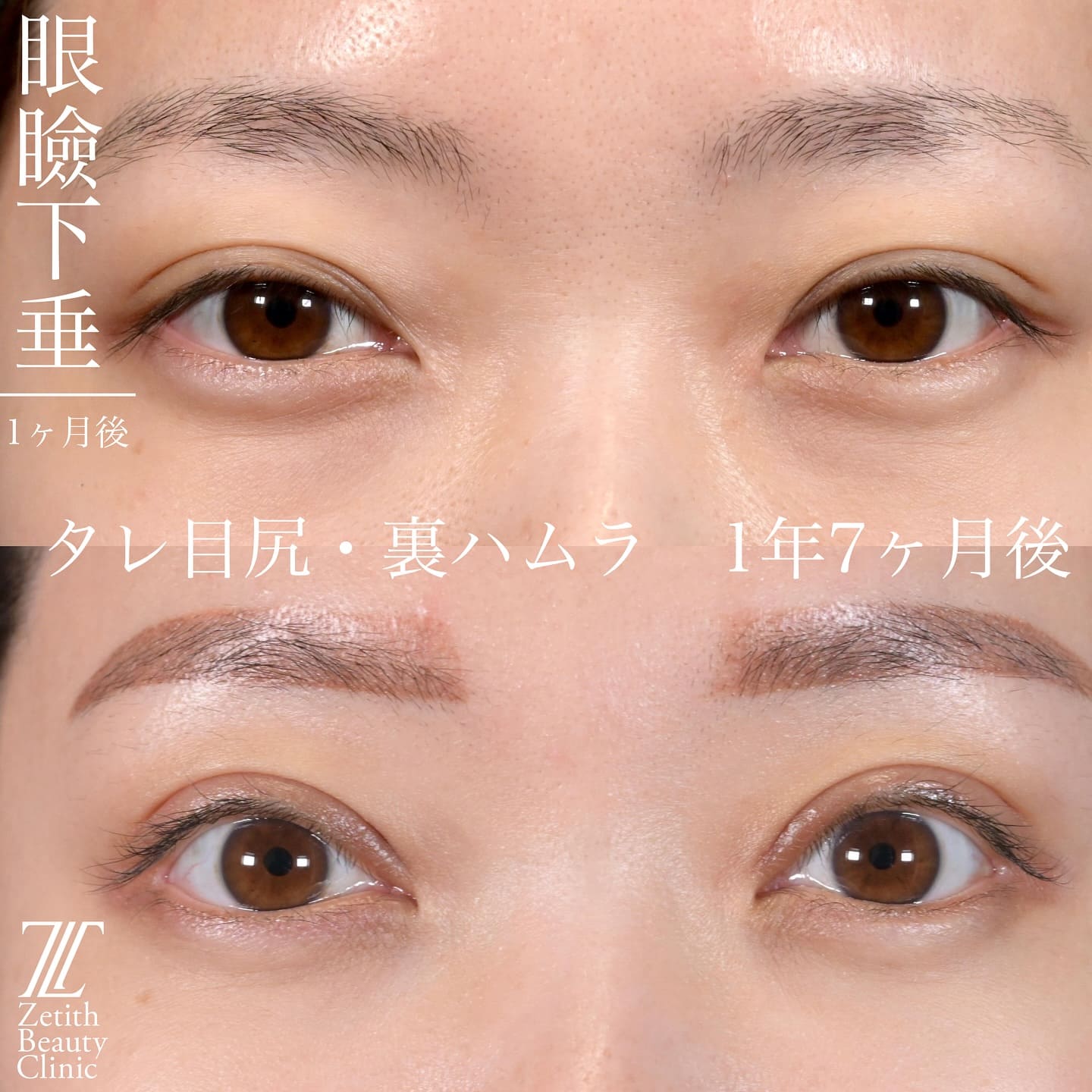 上木原医師による目元整形の術前/術後1ヶ月