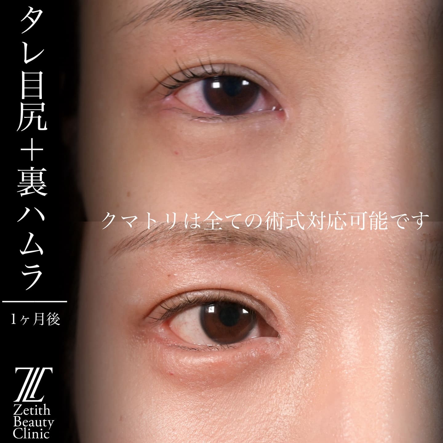 上木原医師による目元整形の術前/術後1ヶ月 术后 