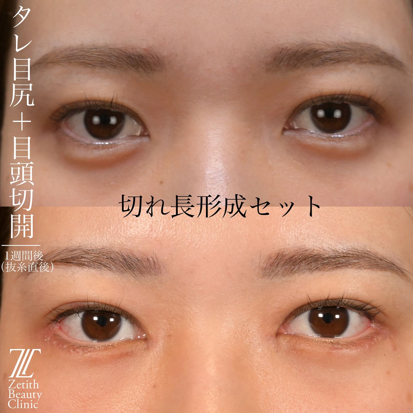上木原医師による目元整形の術前/術後1週間