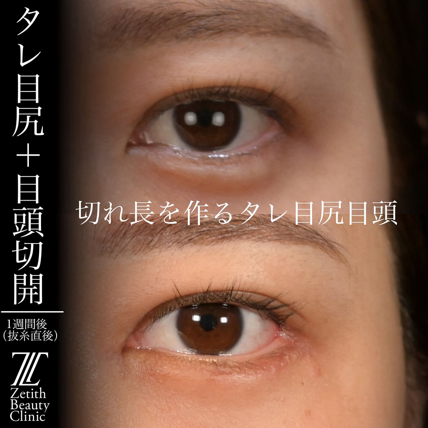 上木原医師による目元整形の術前/術後1週間 After 