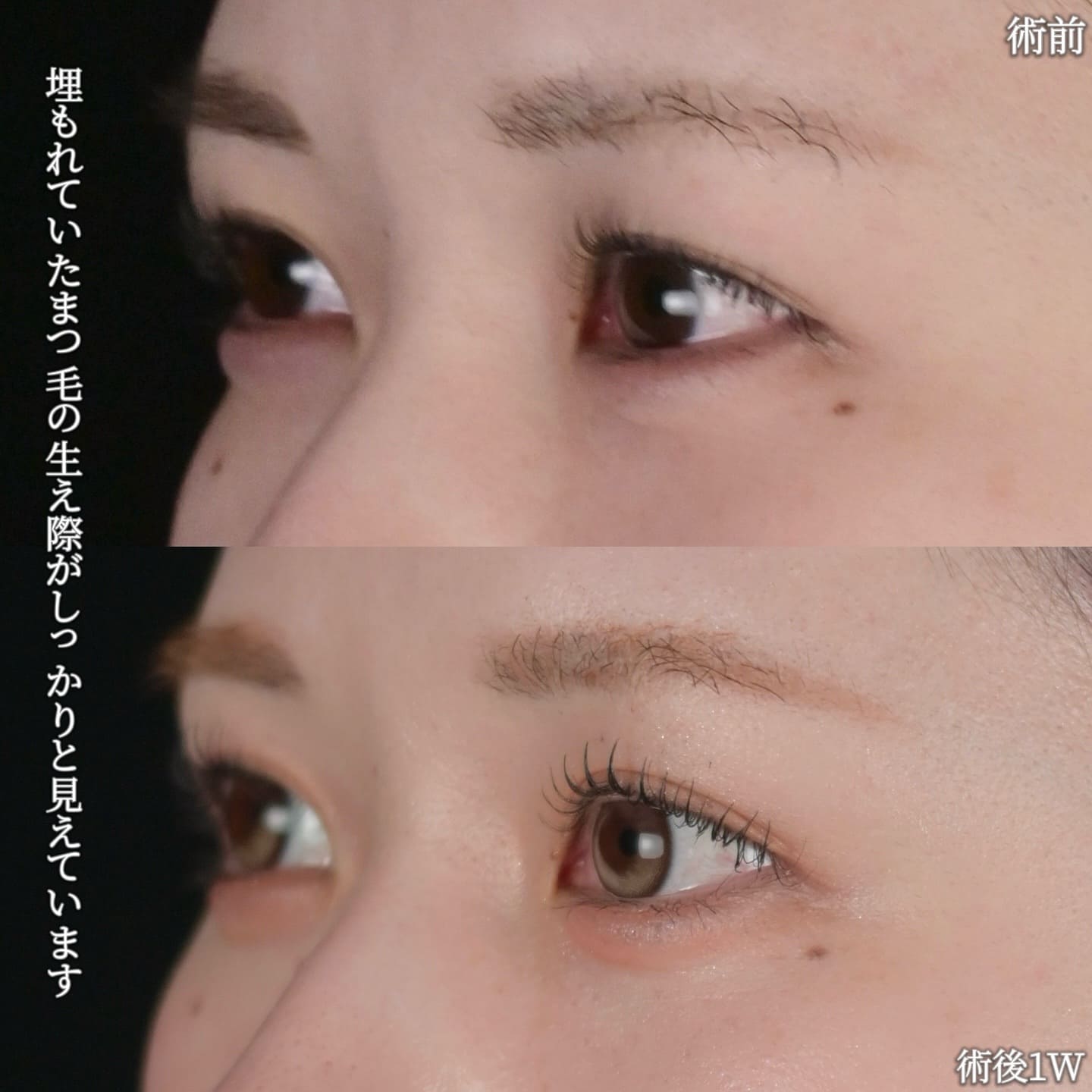 沈医師による目元尾整形の術前/術後1週間 หลัง 