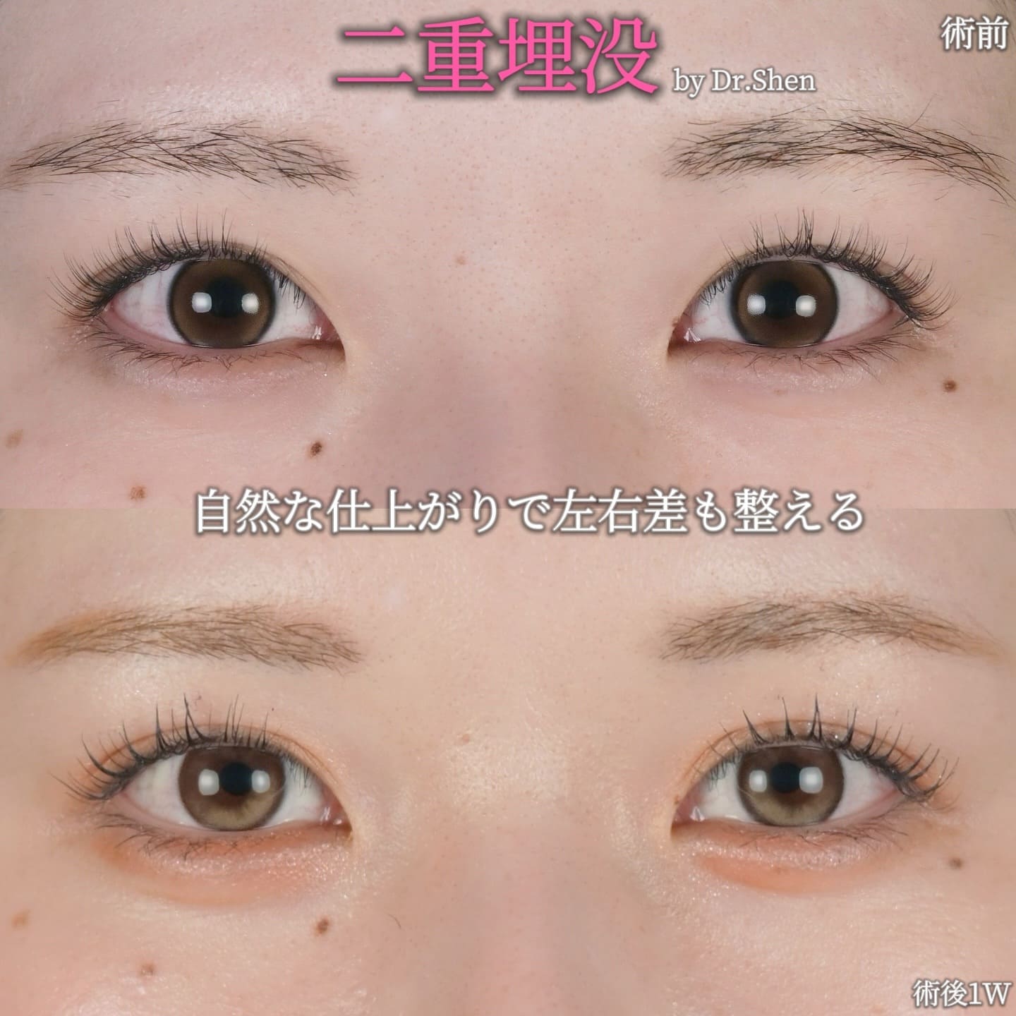 沈医師による目元尾整形の術前/術後1週間