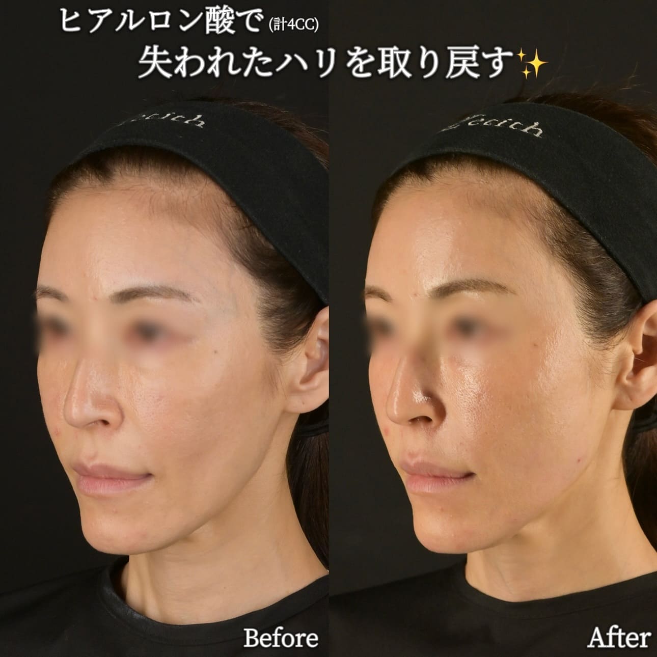 沈医師によるヒアルロン酸注入の術前/術後1ヶ月 | 症例写真 — ゼティス