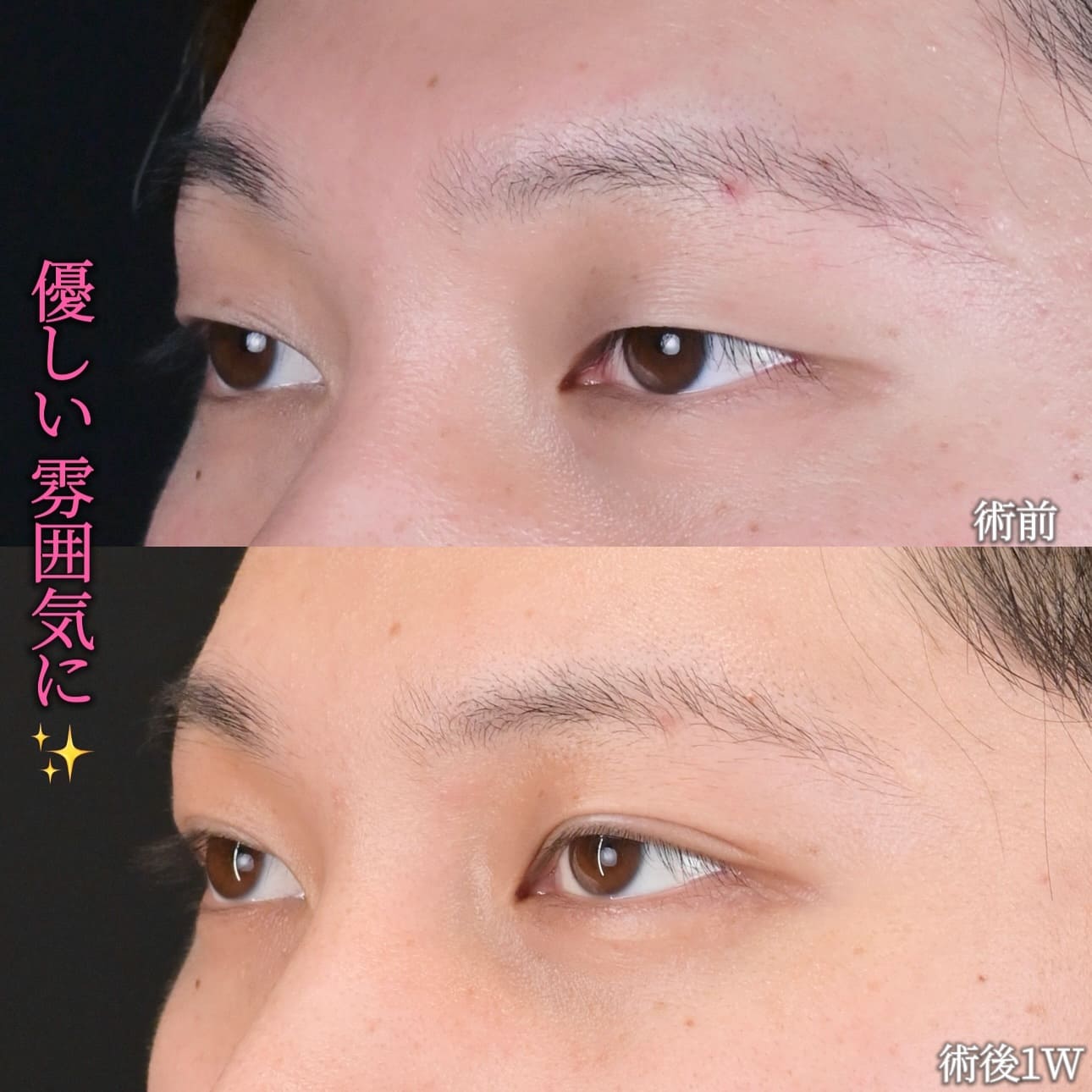 沈医師による目元整形の術前/術後1週間 施術後 