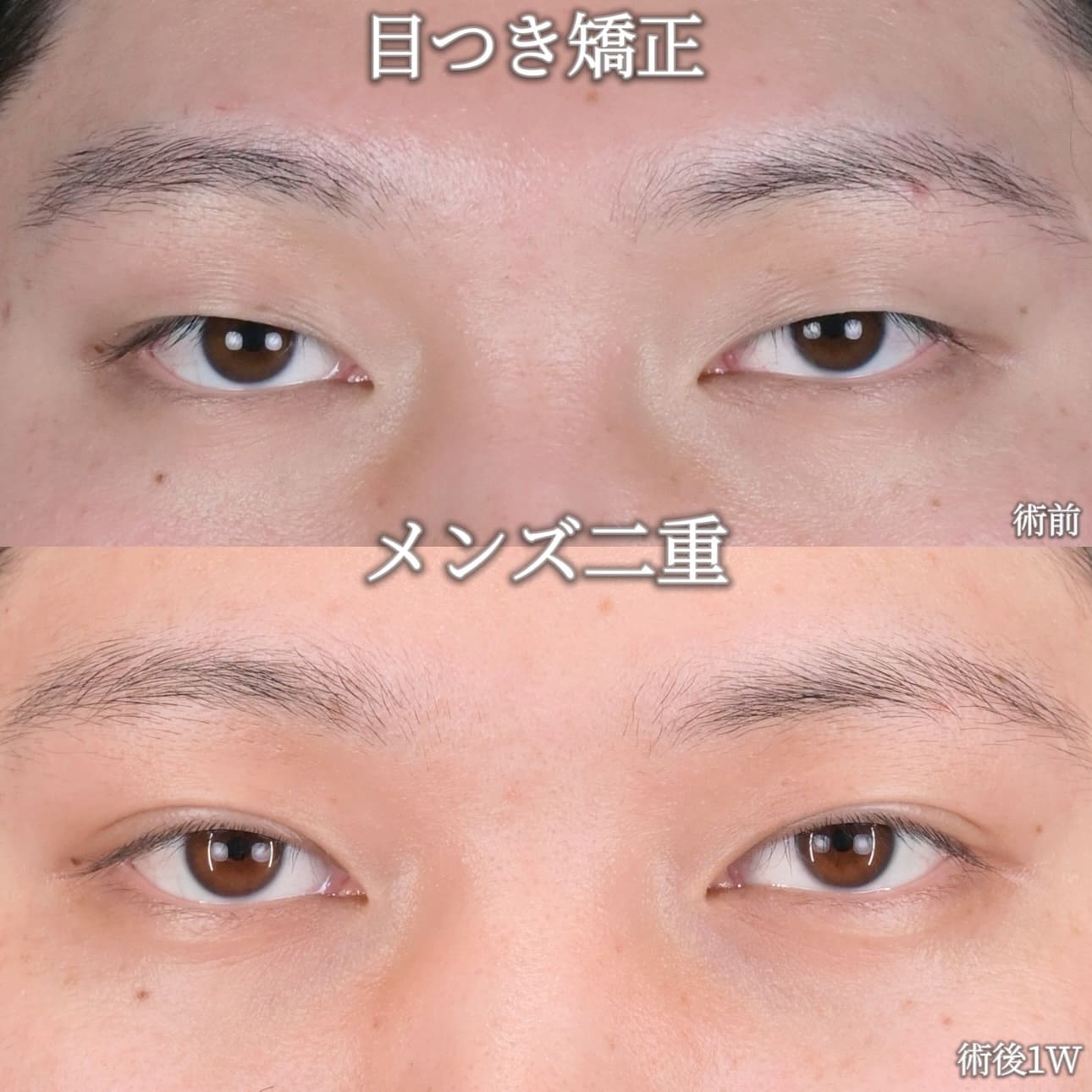 沈医師による目元整形の術前/術後1週間