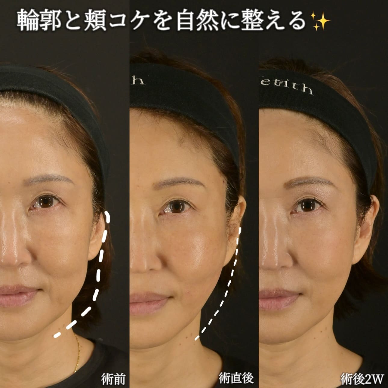 沈医師による鼻整形の術前/術後2週間 施術後 