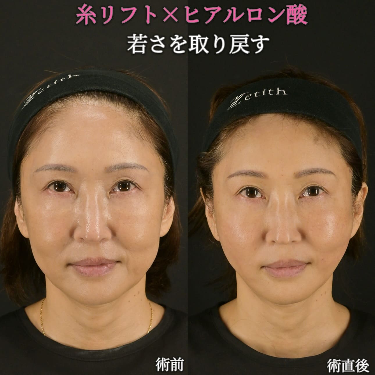 沈医師による鼻整形の術前/術後2週間