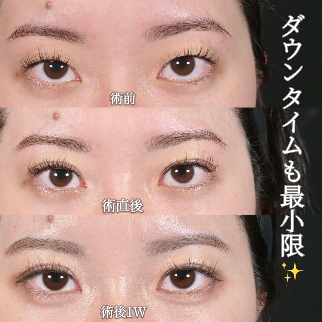 沈医師による目元整形の術前/術後1週間 施術後 