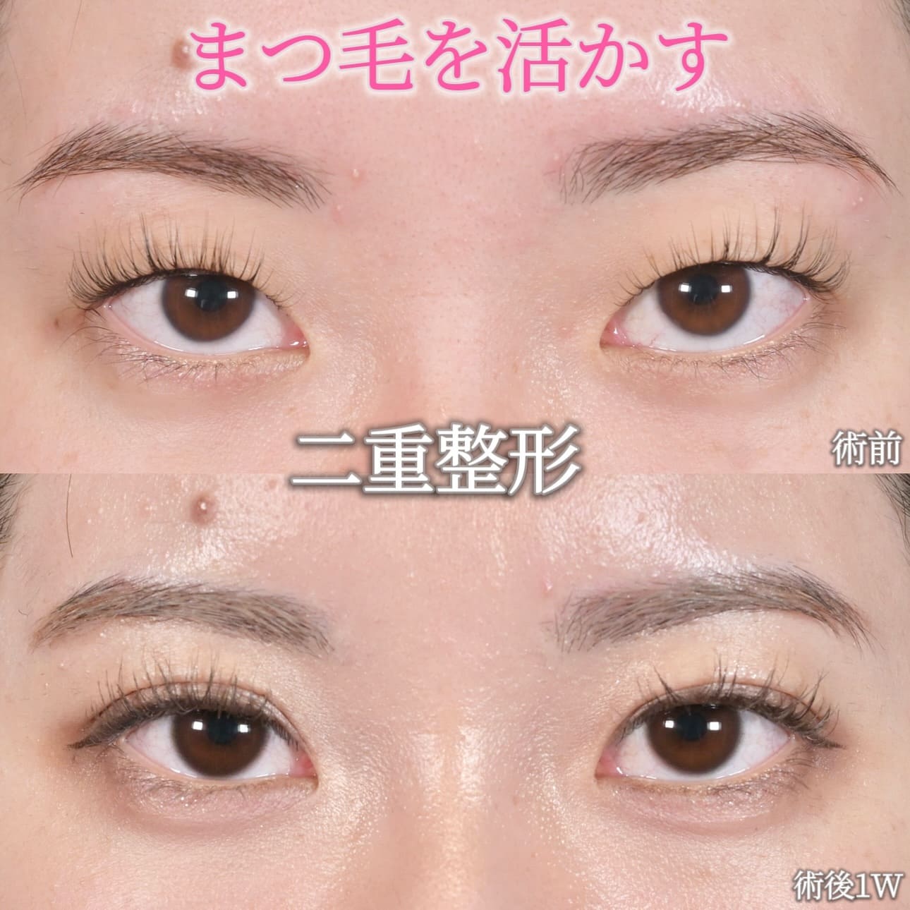 沈医師による目元整形の術前/術後1週間