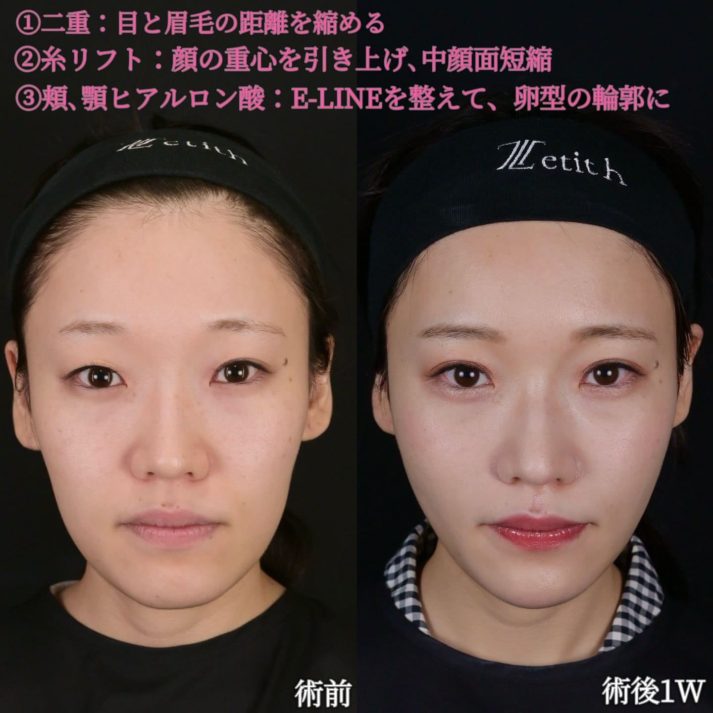 沈医師による鼻整形の術前/術後1週間