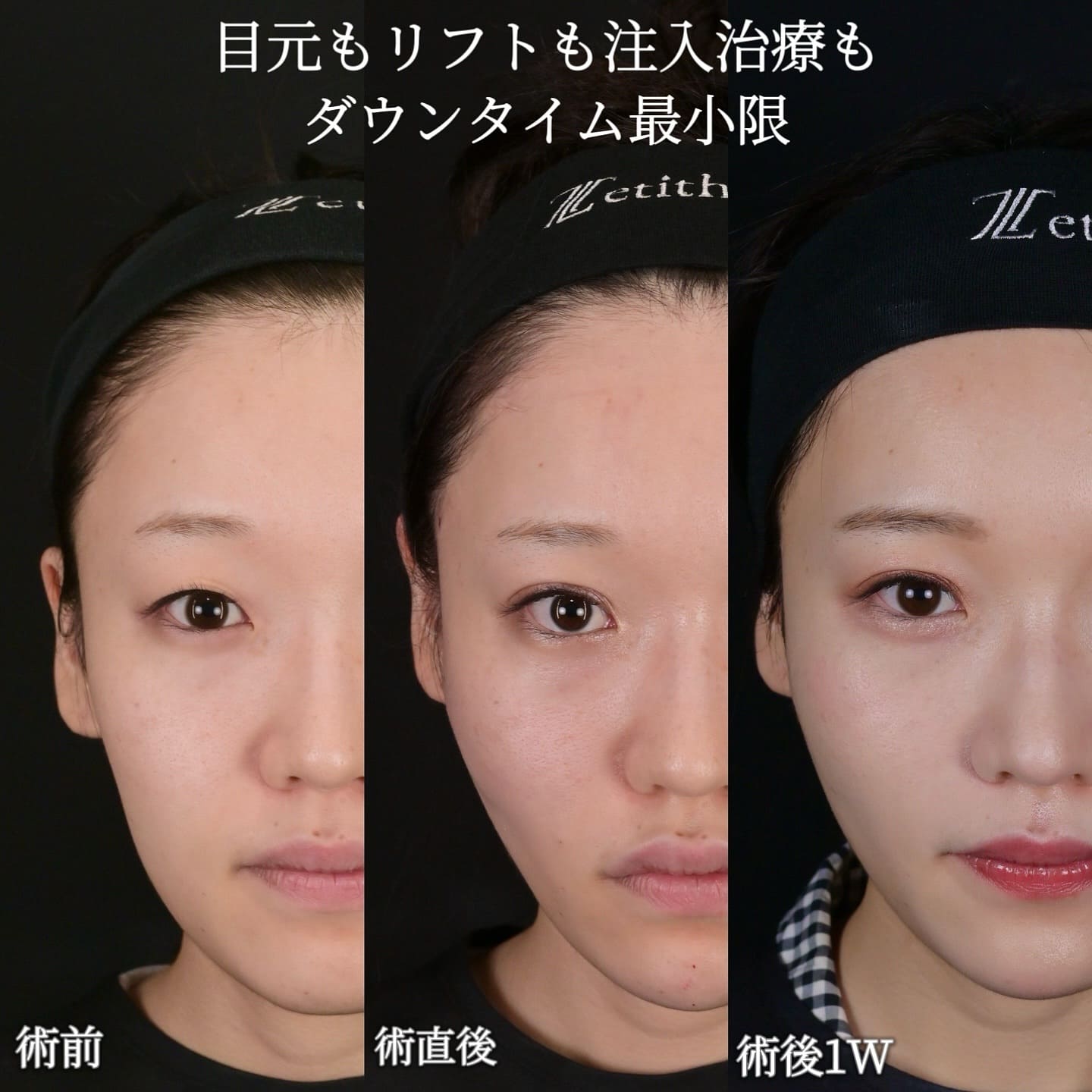 沈医師による鼻整形の術前/術後1週間 Дараа 