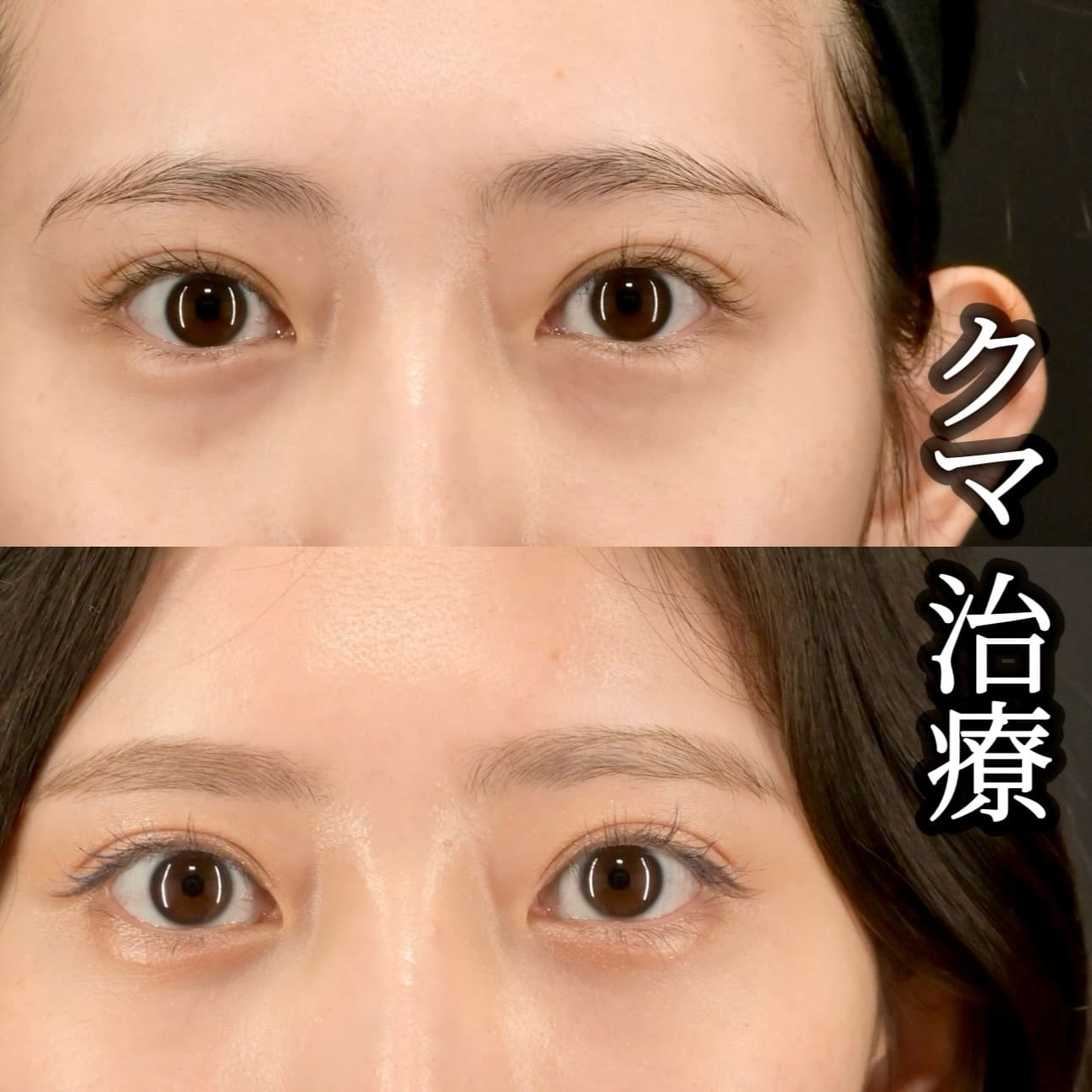 沈医師による目の下の切らないクマ取りの術前/術後1ヶ月
