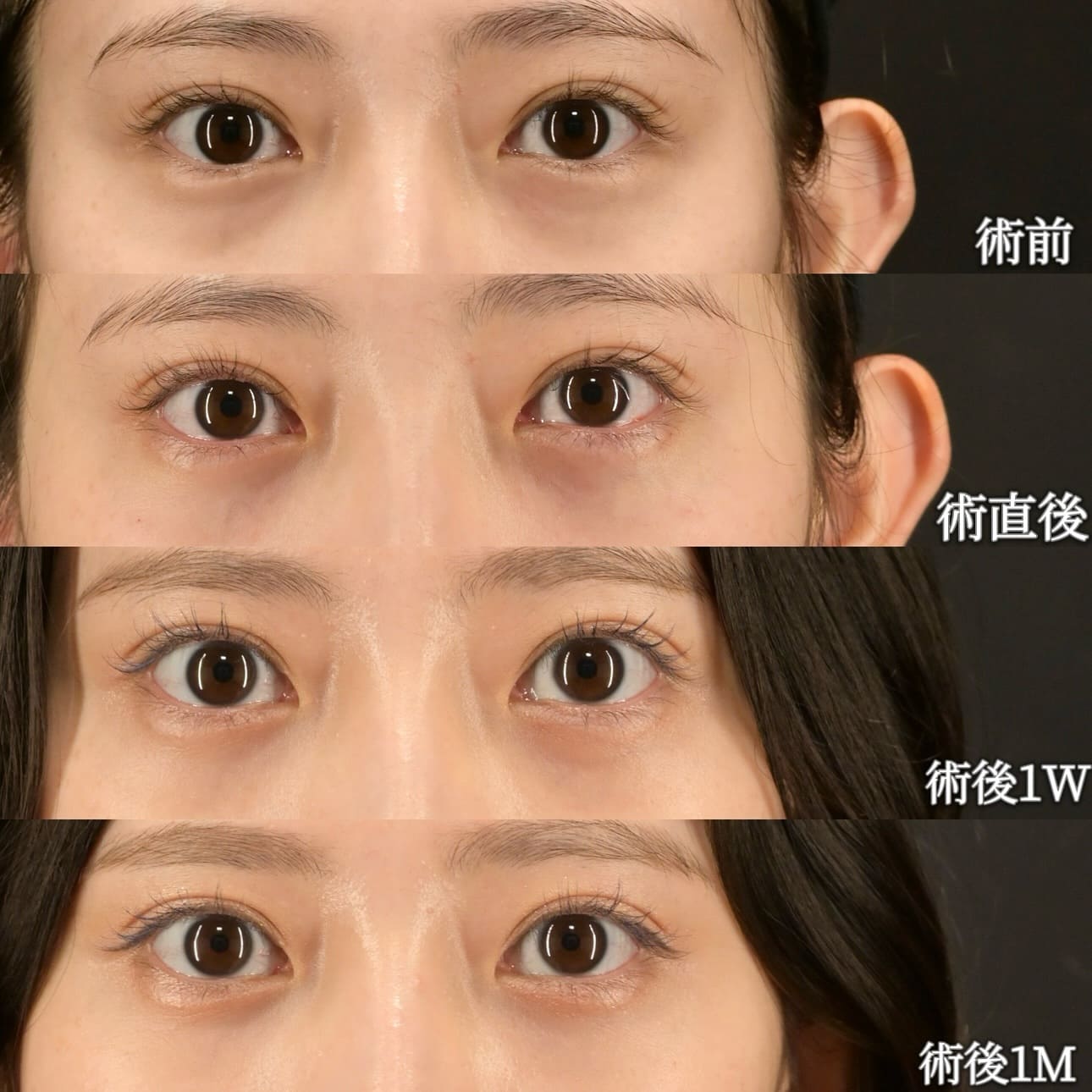 沈医師による目の下の切らないクマ取りの術前/術後1ヶ月 بعد 