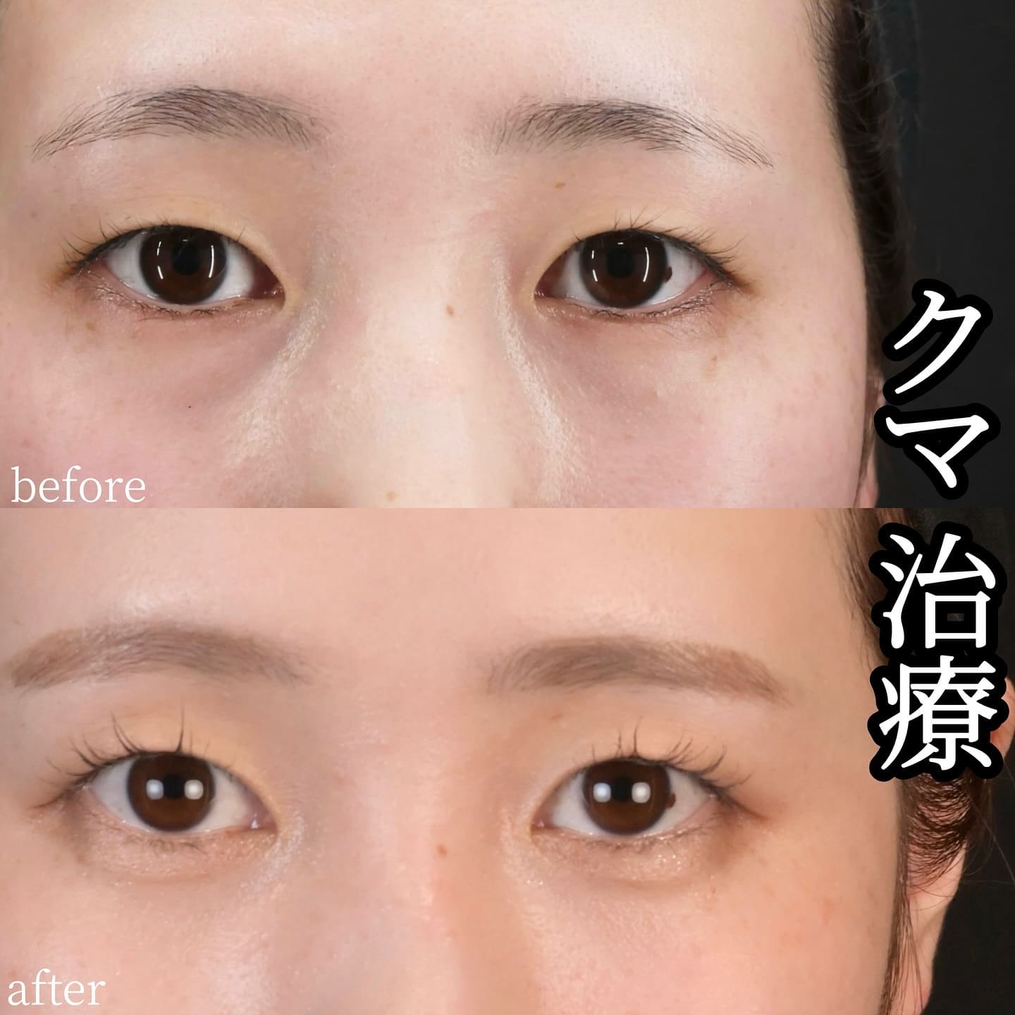 沈医師による切らないクマ取りの術前/術後３ヶ月