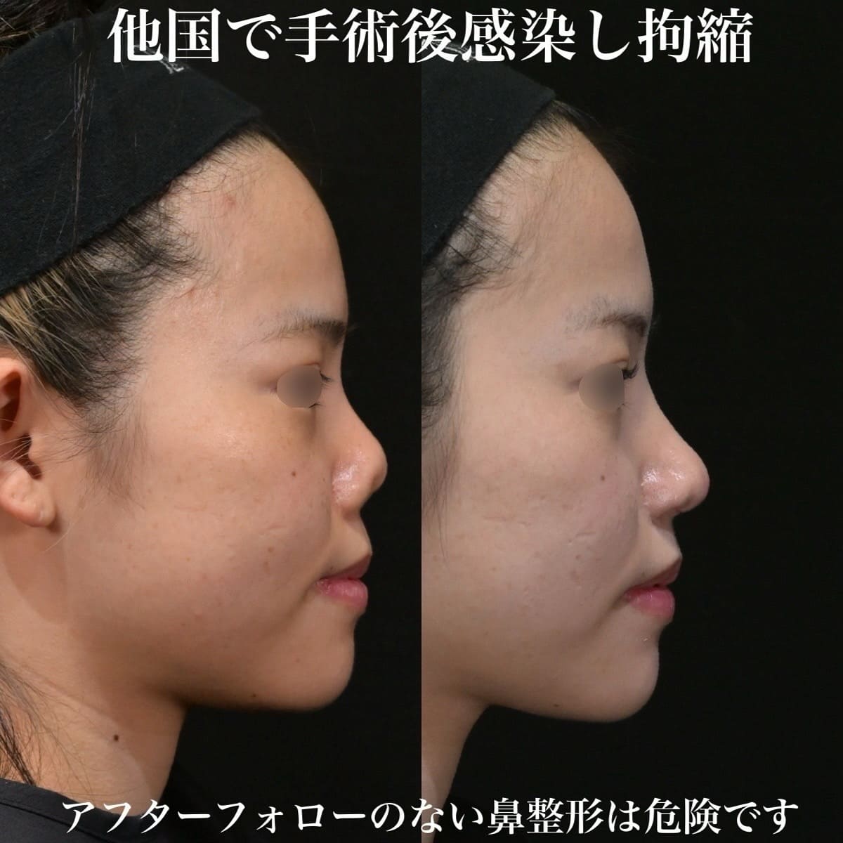 鉄医師による鼻整形の術前/術後1年 หลัง 