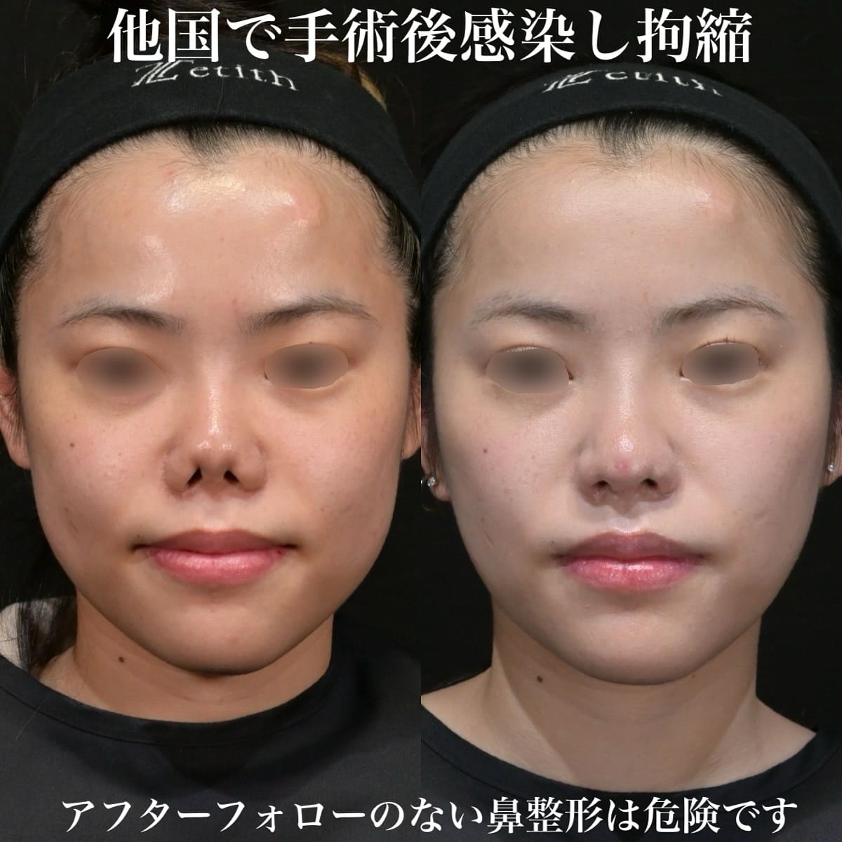 鉄医師による鼻整形の術前/術後1年