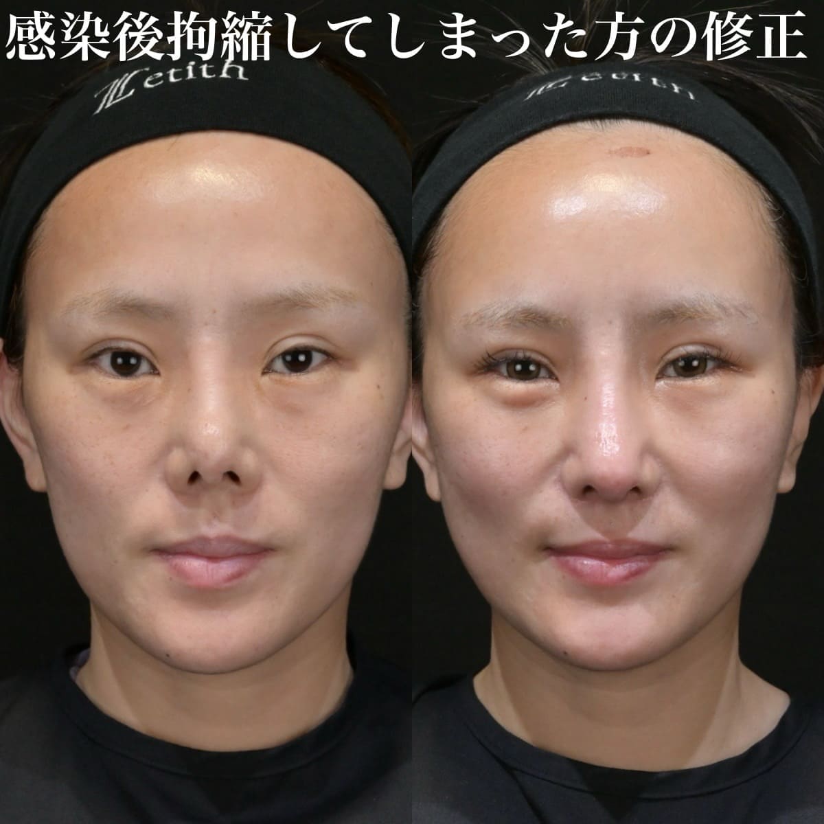 鉄医師による鼻整形の術前/術後1ヶ月
