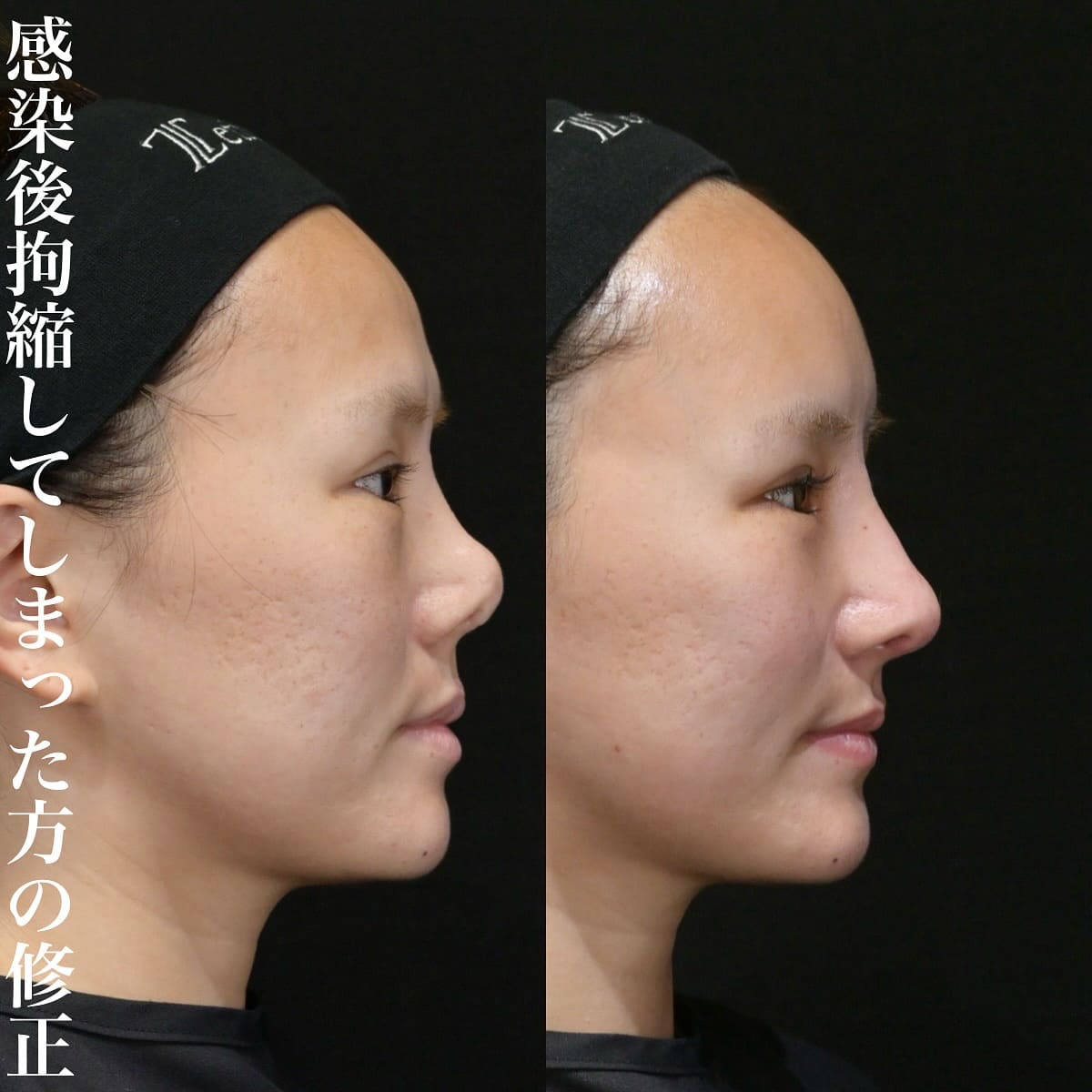 鉄医師による鼻整形の術前/術後1ヶ月 施術後 