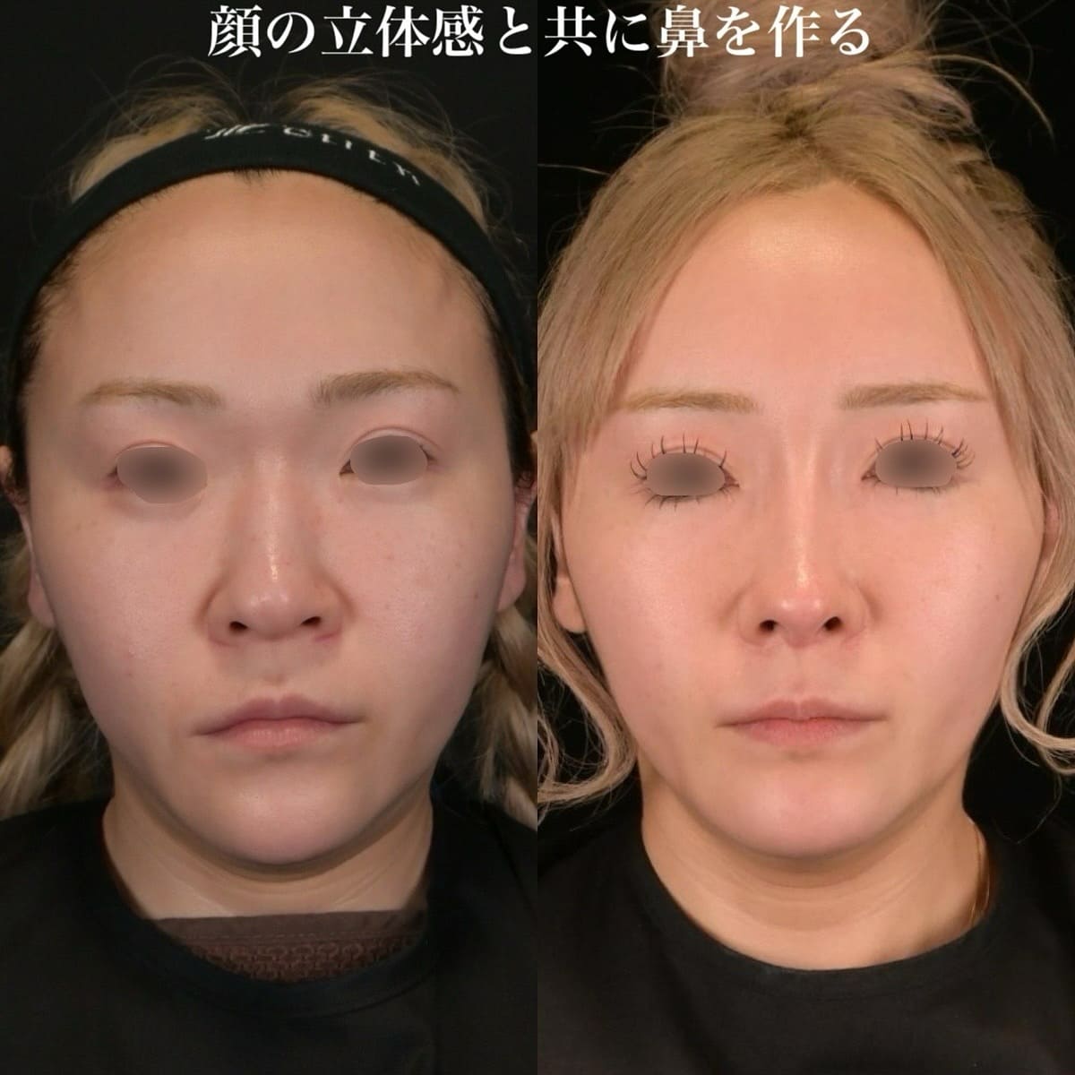 鉄医師による鼻整形の術前/術後6ヶ月