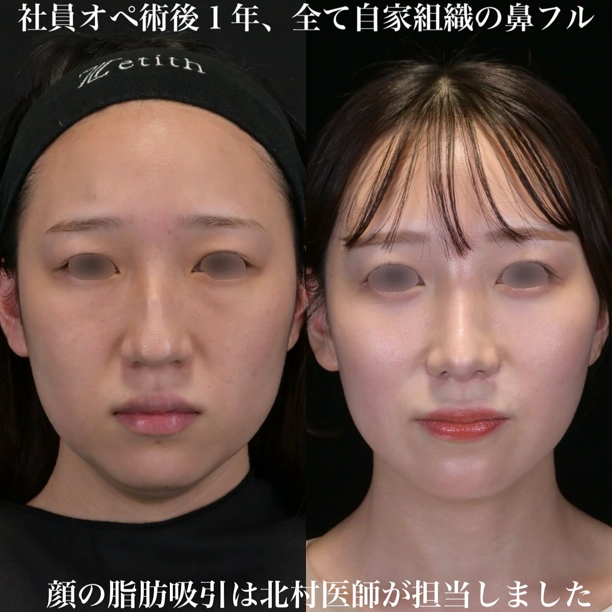 鉄医師による鼻整形の術前/術後1年