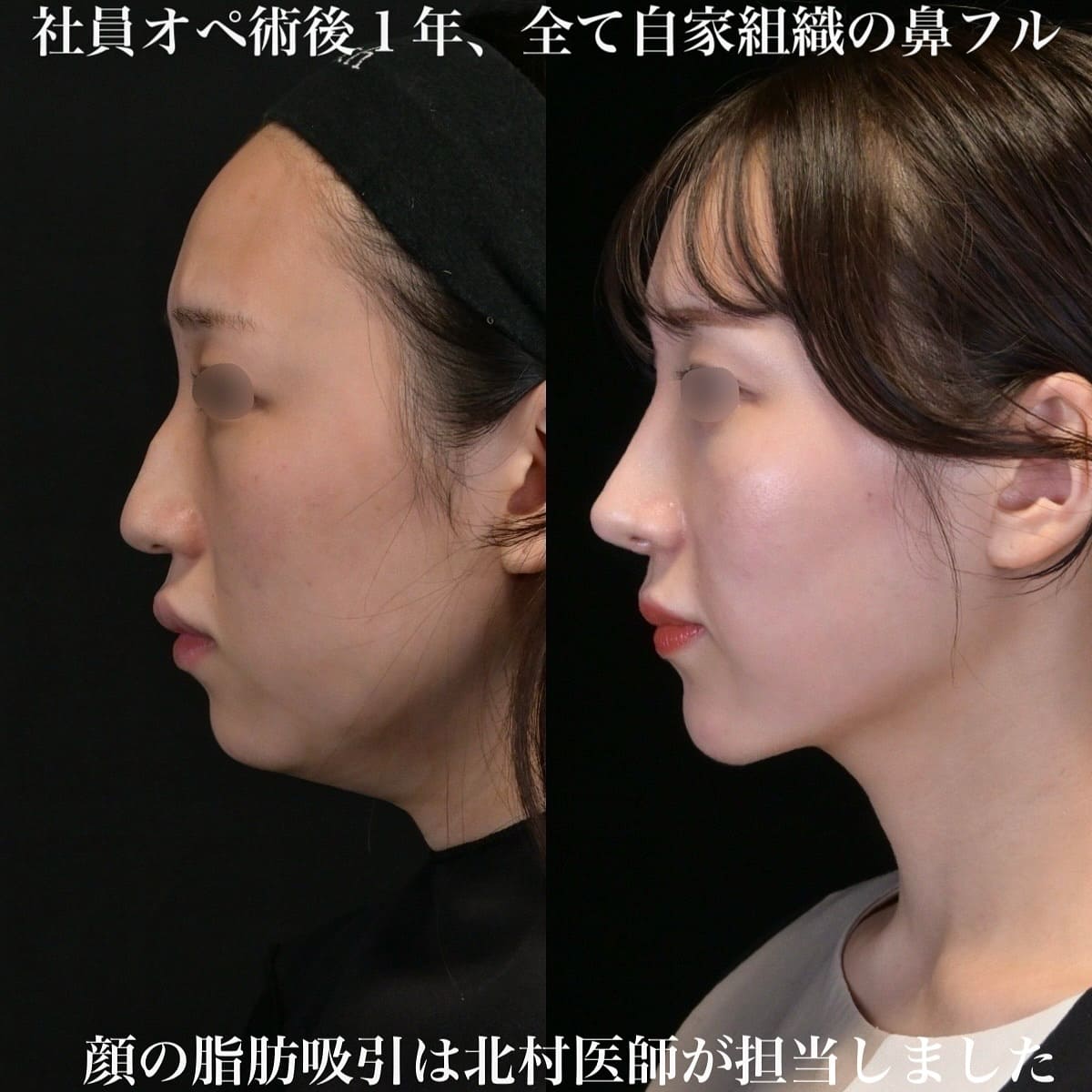 鉄医師による鼻整形の術前/術後1年 施術後 