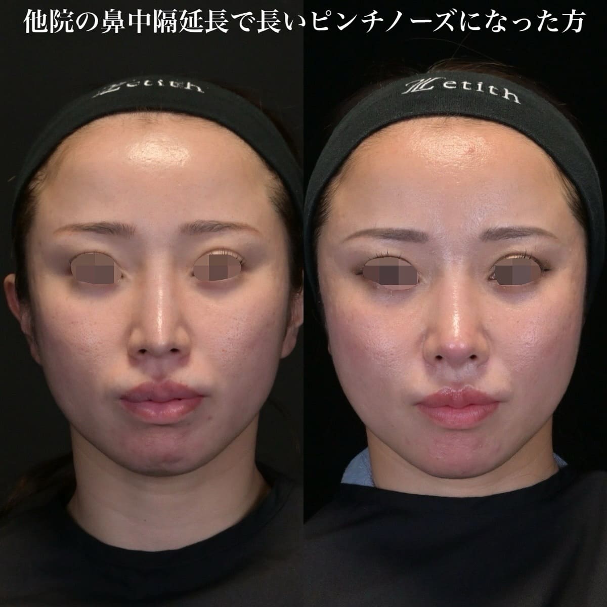 鉄医師による鼻整形の術前/術後6ヶ月