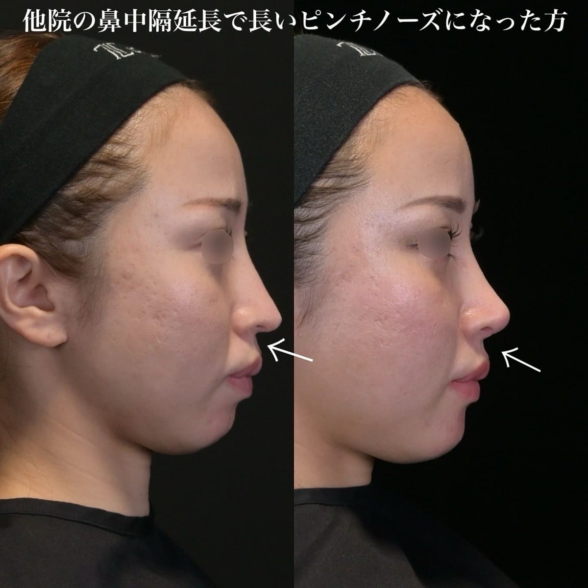 鉄医師による鼻整形の術前/術後6ヶ月 施術後 