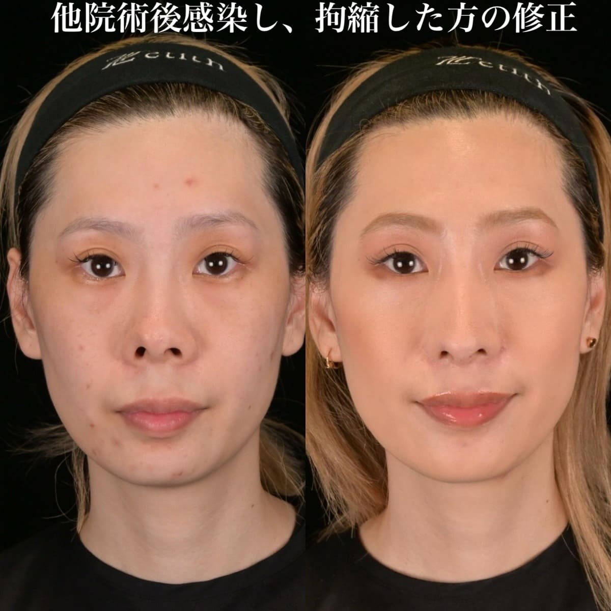 鉄医師による鼻整形の術前/術後３ヶ月
