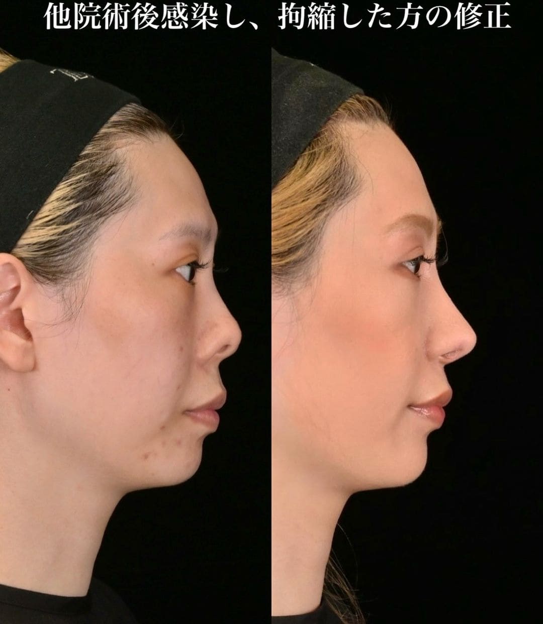鉄医師による鼻整形の術前/術後３ヶ月 施術後 