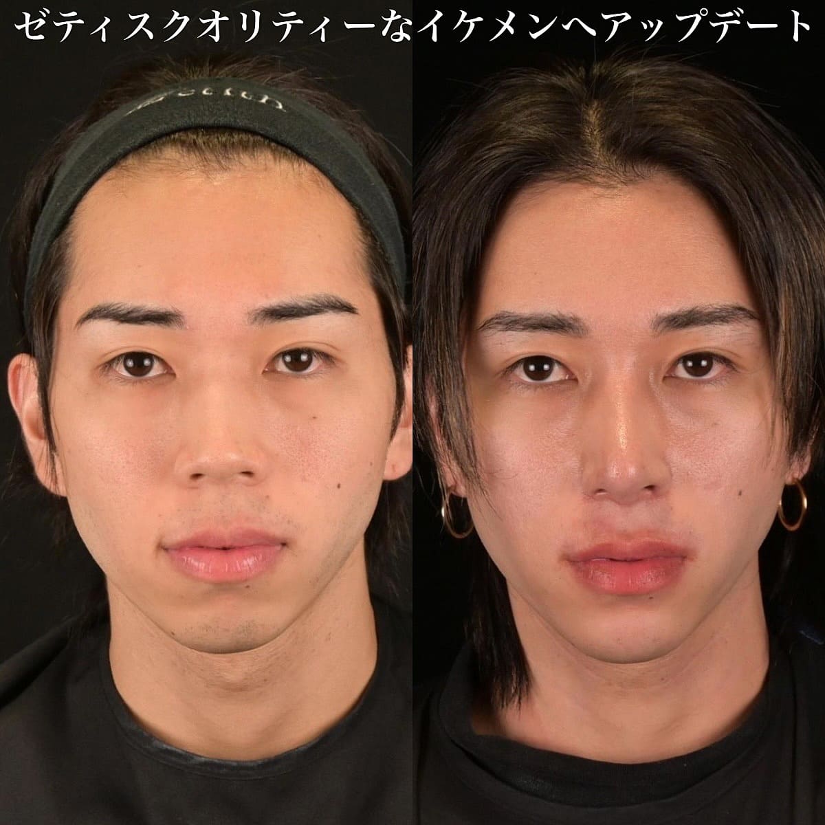 鉄医師による鼻整形の術前/術後３ヶ月