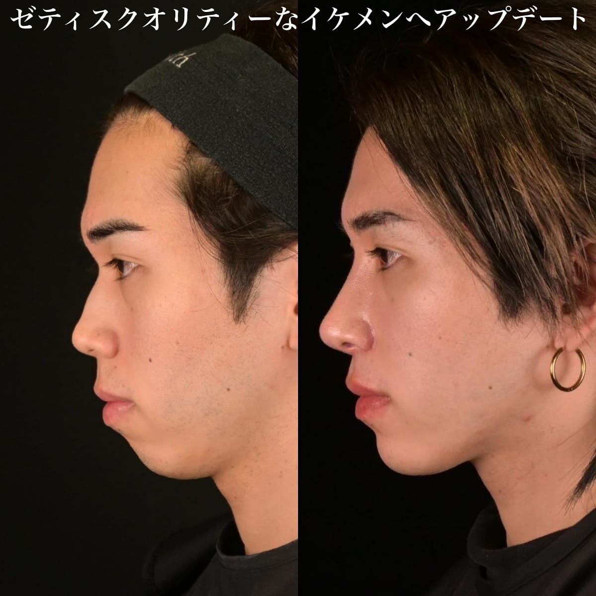 鉄医師による鼻整形の術前/術後３ヶ月 术后 