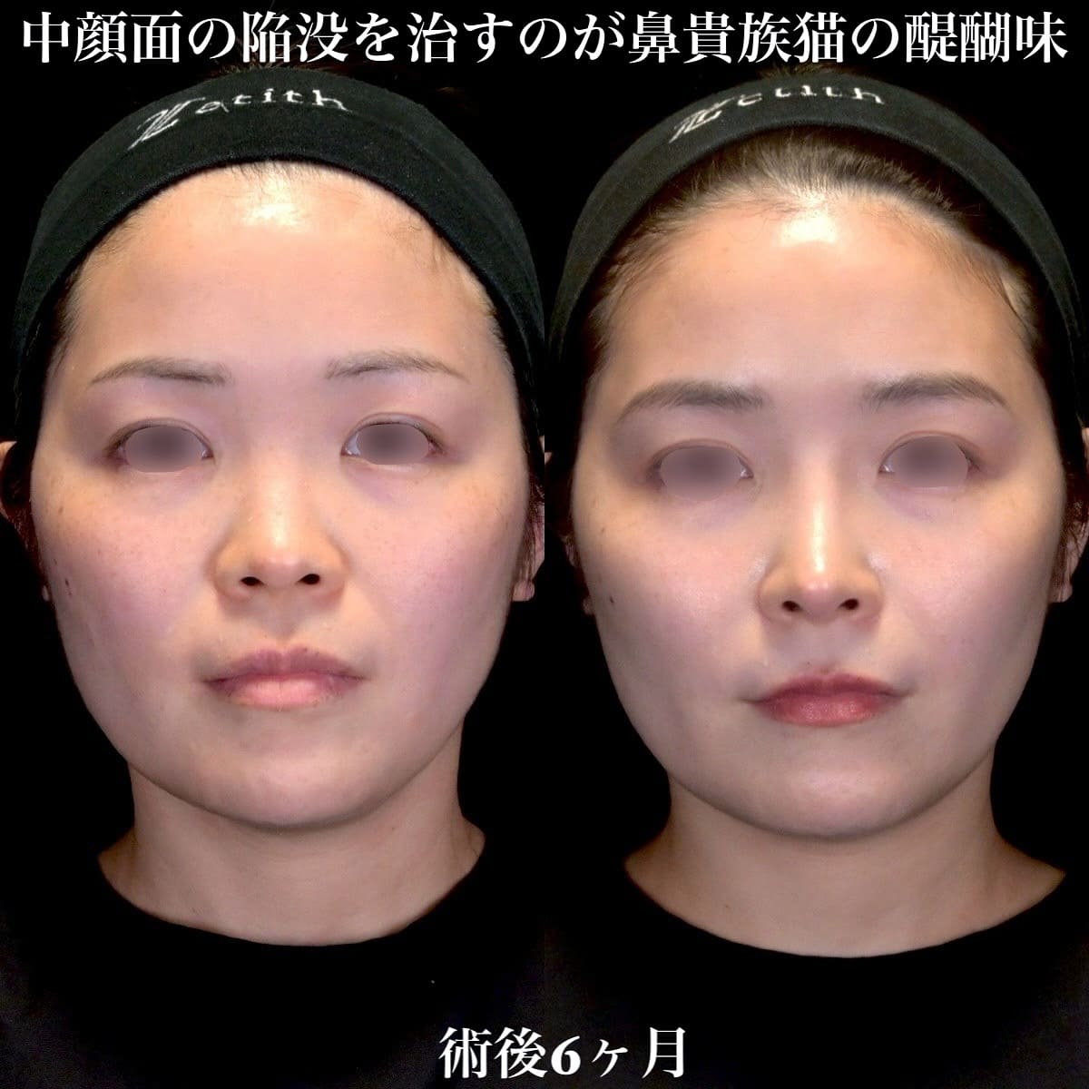鉄医師による鼻整形の術前/術後6ヶ月