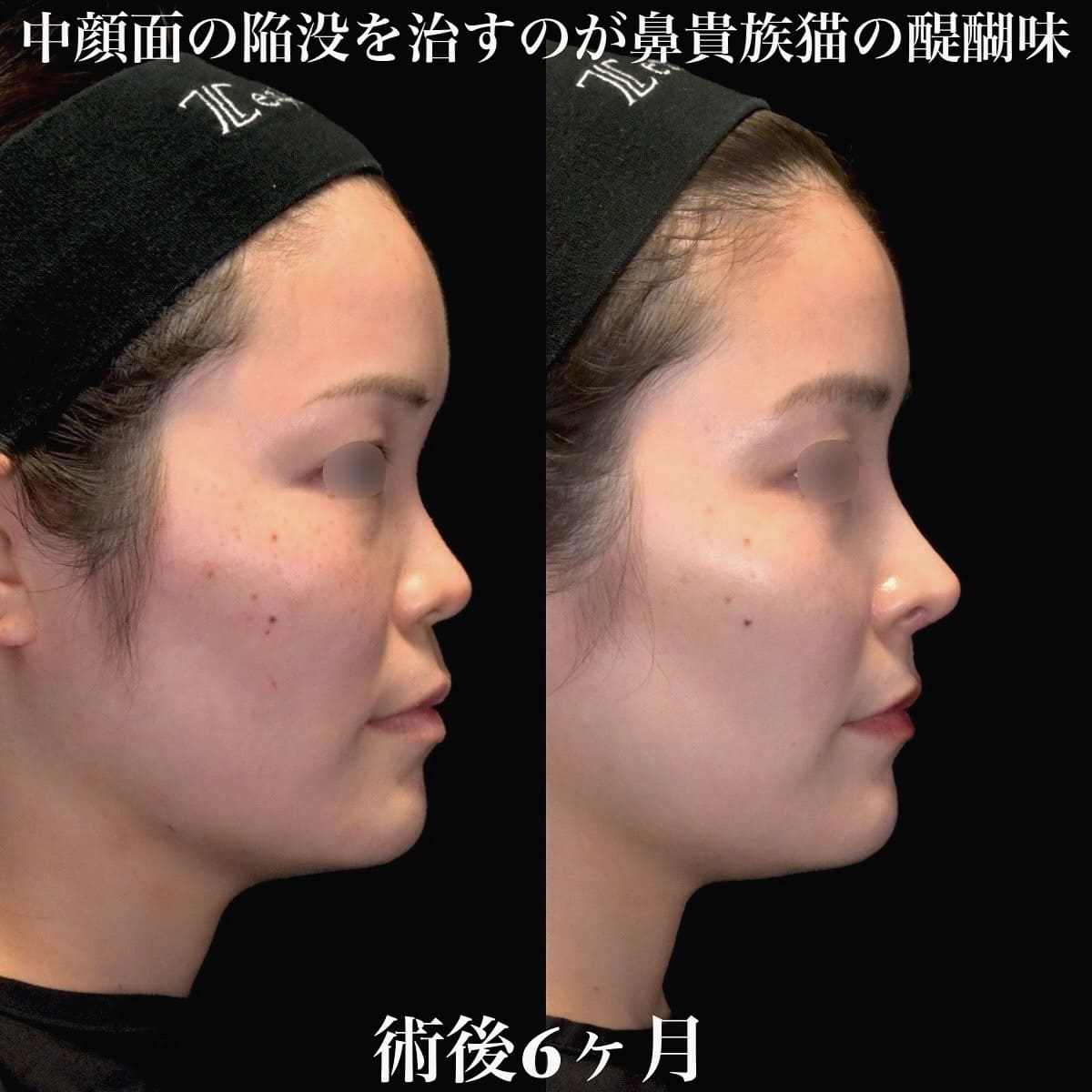 鉄医師による鼻整形の術前/術後6ヶ月 术后 
