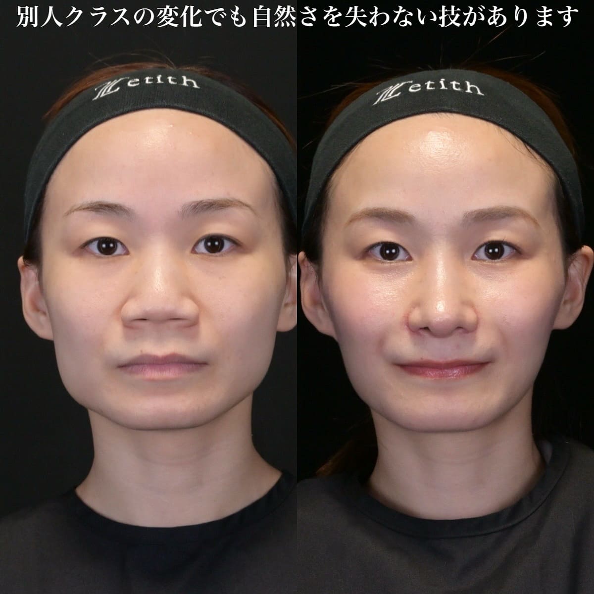 鉄医師による鼻整形の術前/術後3ヶ月