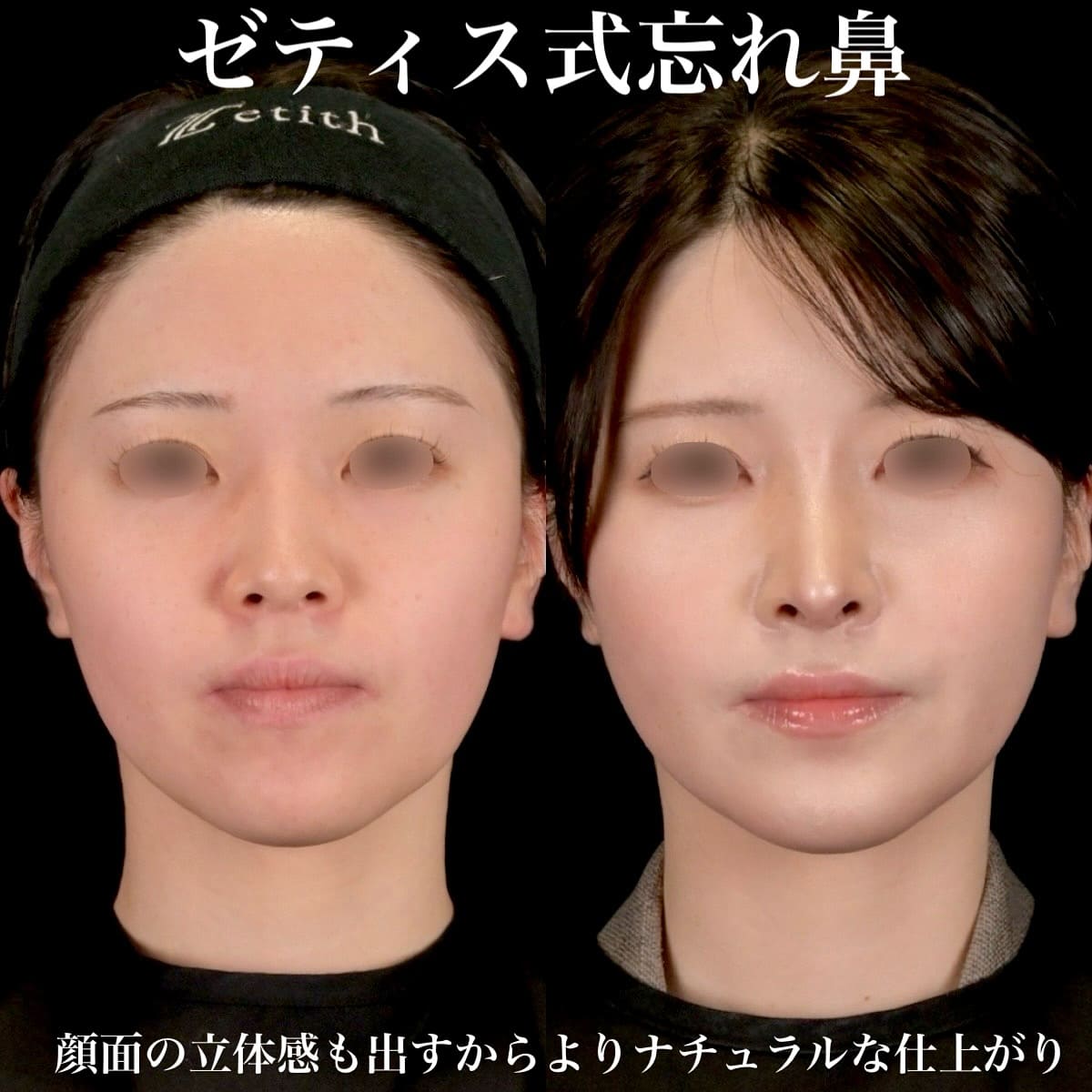 鉄医師による鼻整形の術前/術後1ヶ月 施術後 