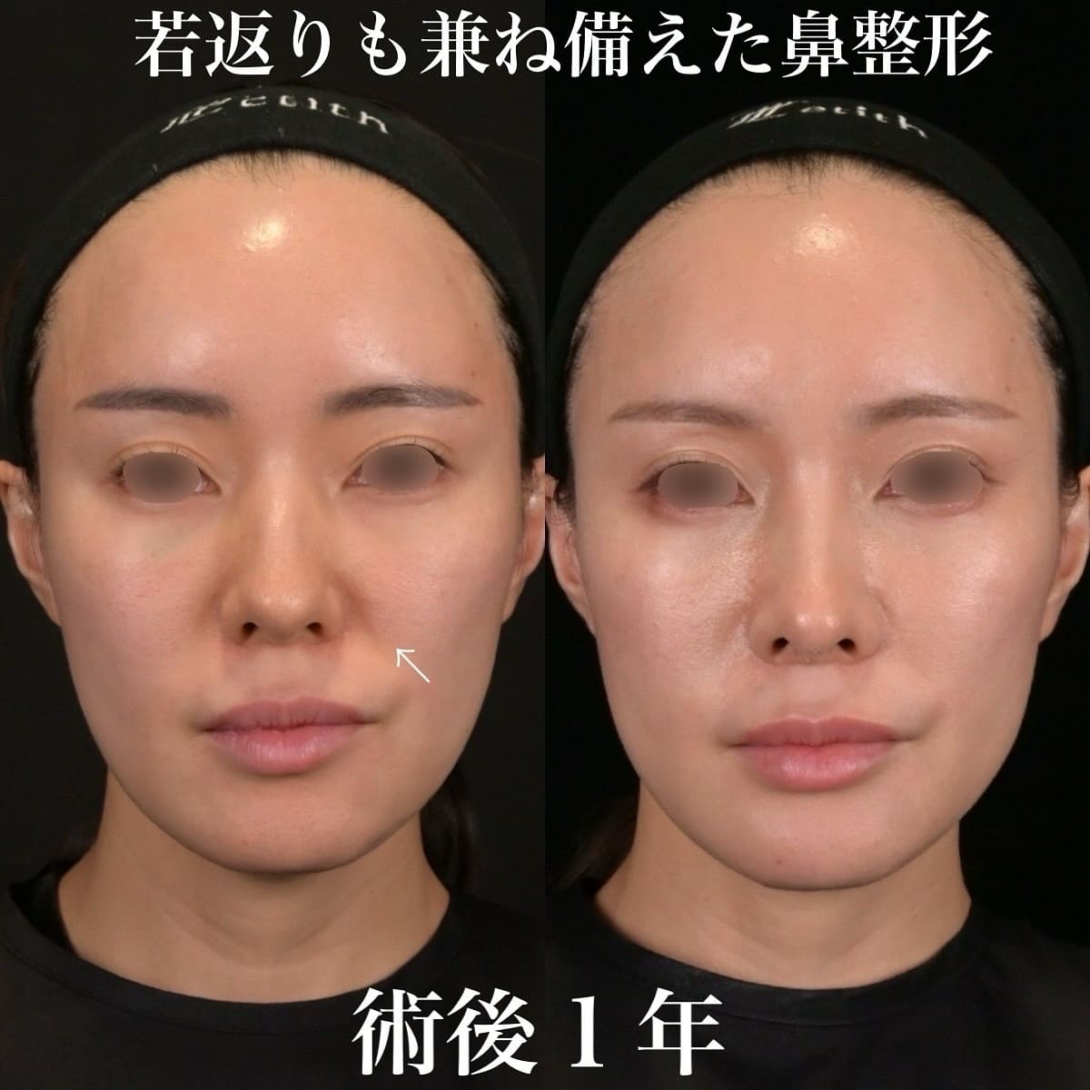 鉄医師による鼻整形の術前/術後1年