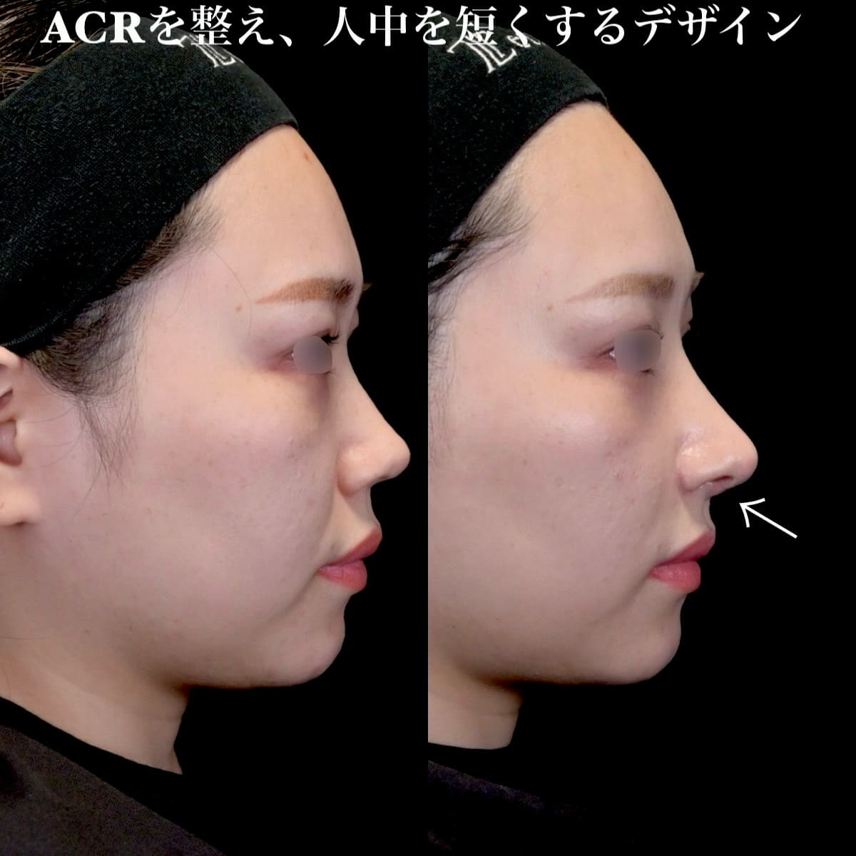鉄医師による鼻整形の術前/術後1ヶ月 施術後 