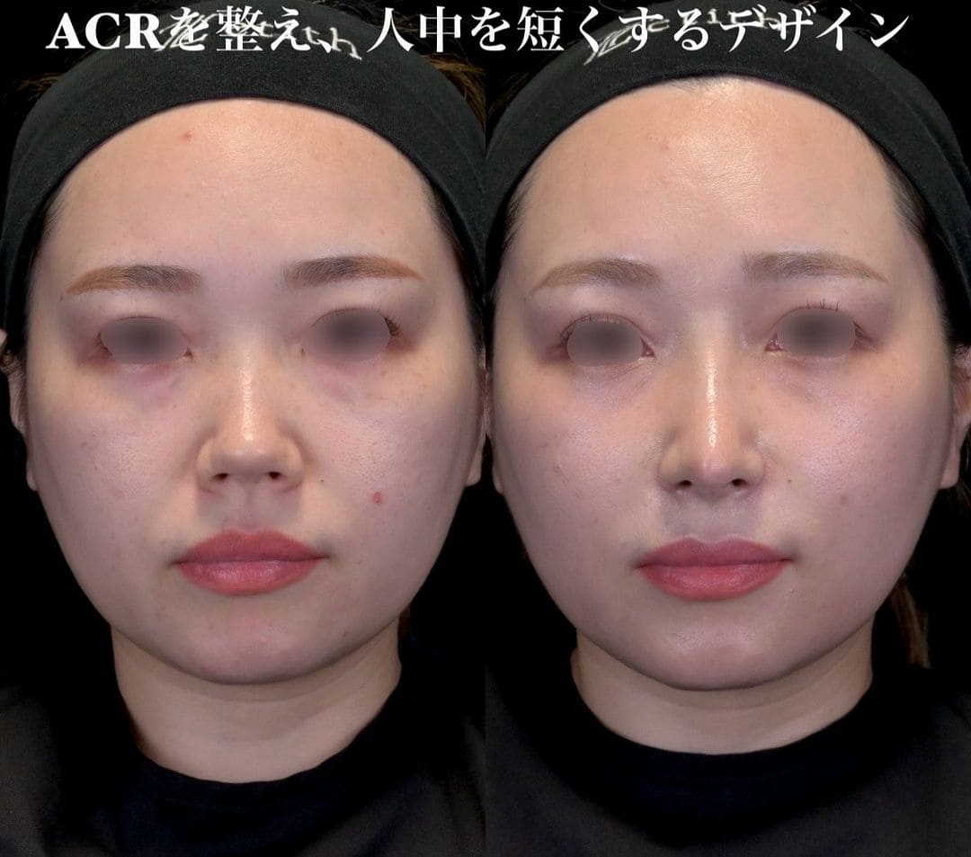 鉄医師による鼻整形の術前/術後1ヶ月